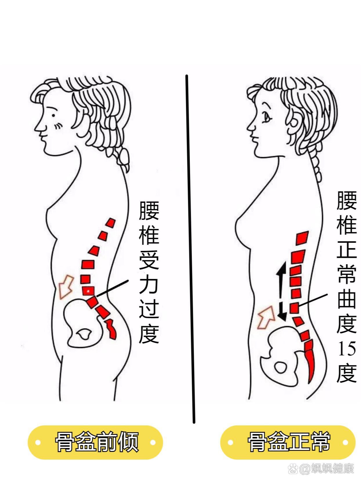 骨盆前倾角度图片