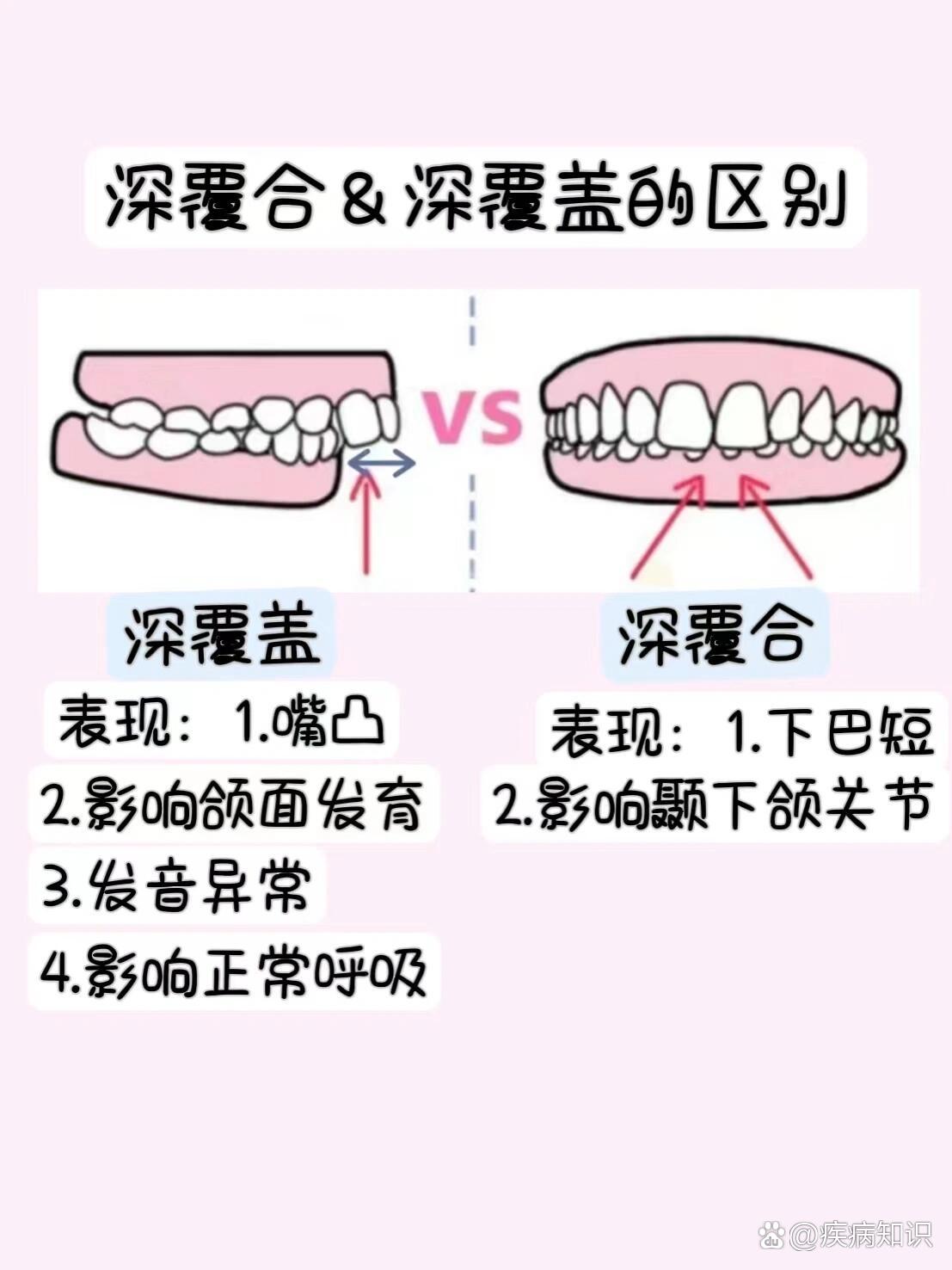 深覆合和深覆盖区别图片