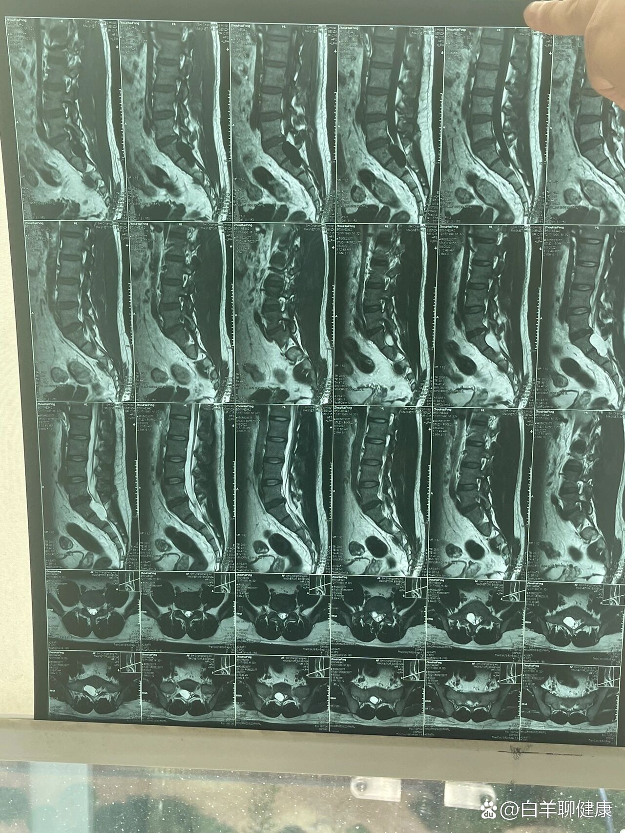 骶管囊肿