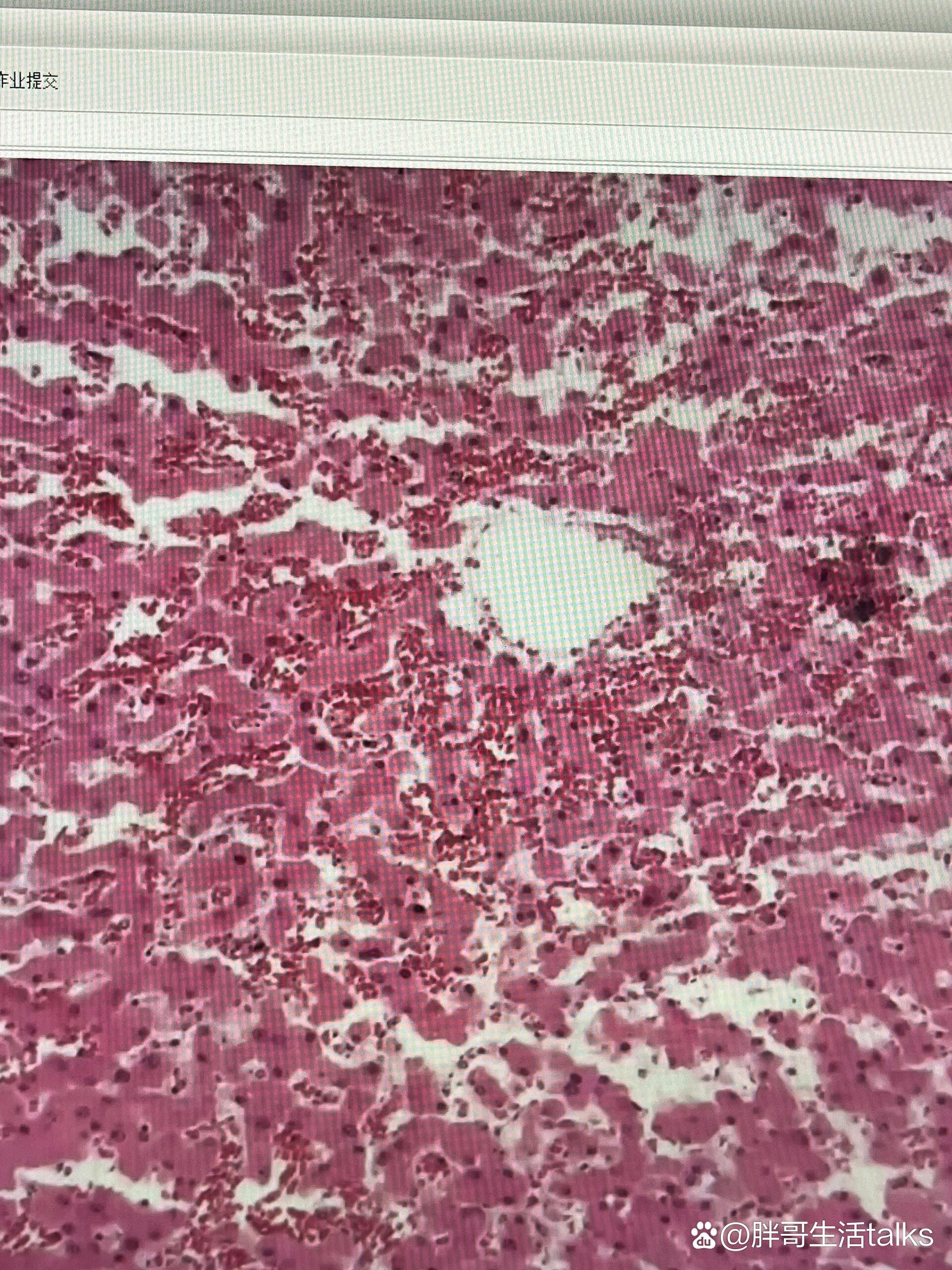 肝淤血切片图图片