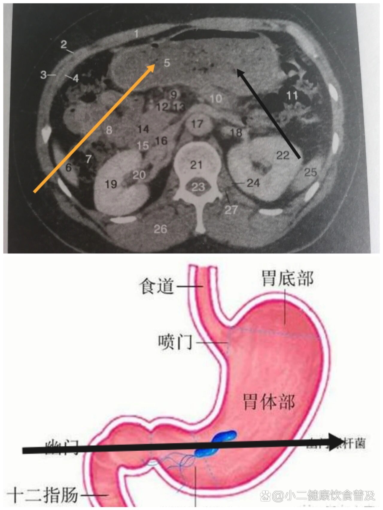 胃的ct横断面解剖