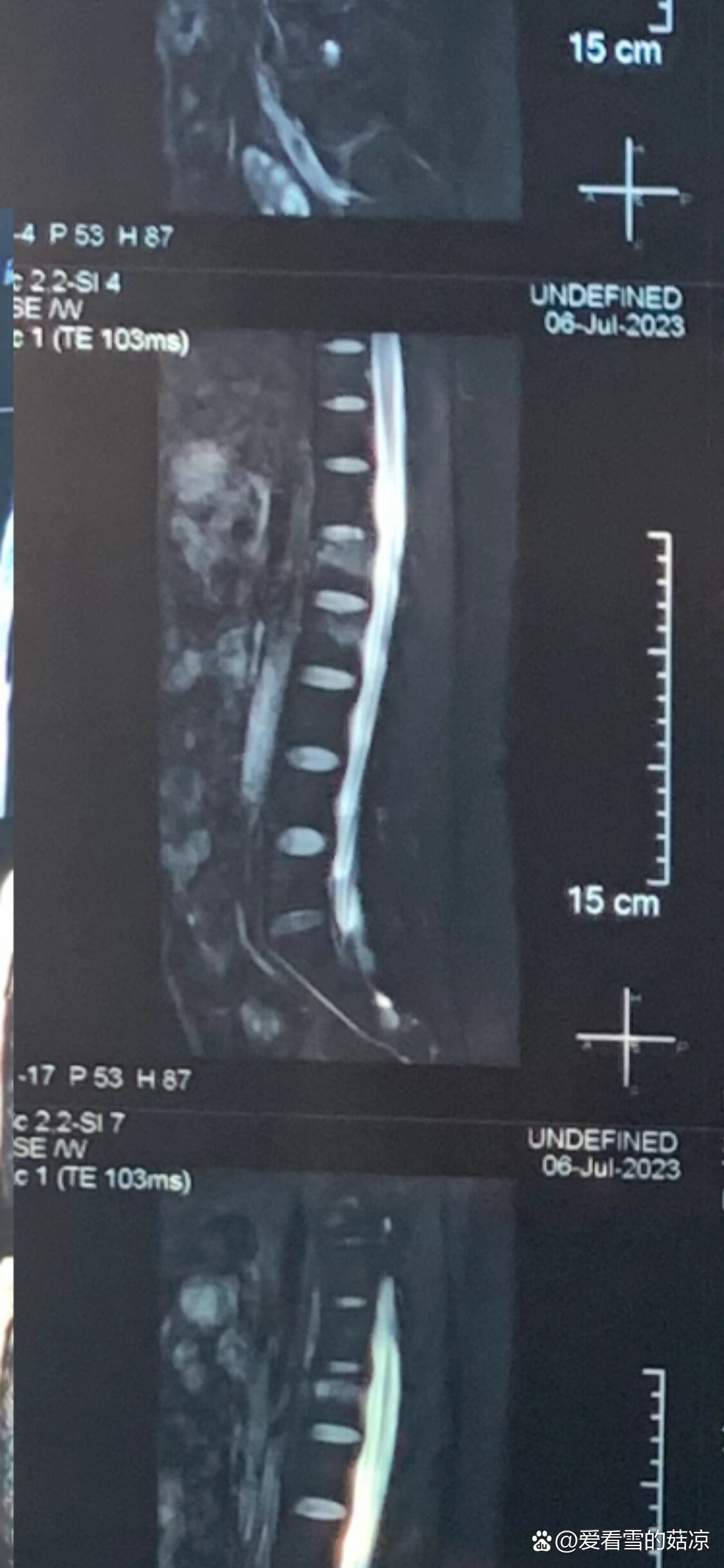 腰椎l1l2压缩性骨折保守治要多久才能下地呢