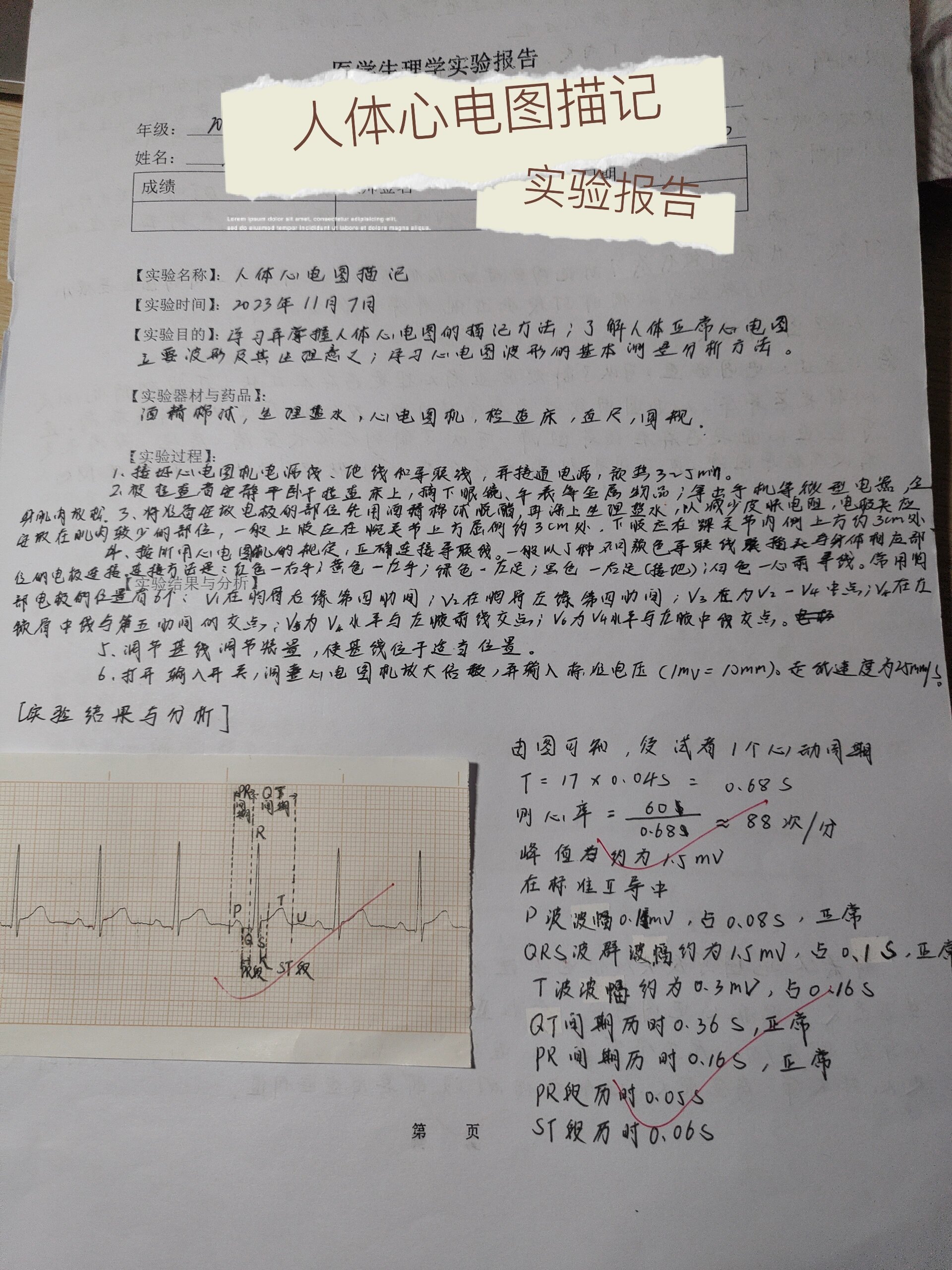 心电图实验报告图片