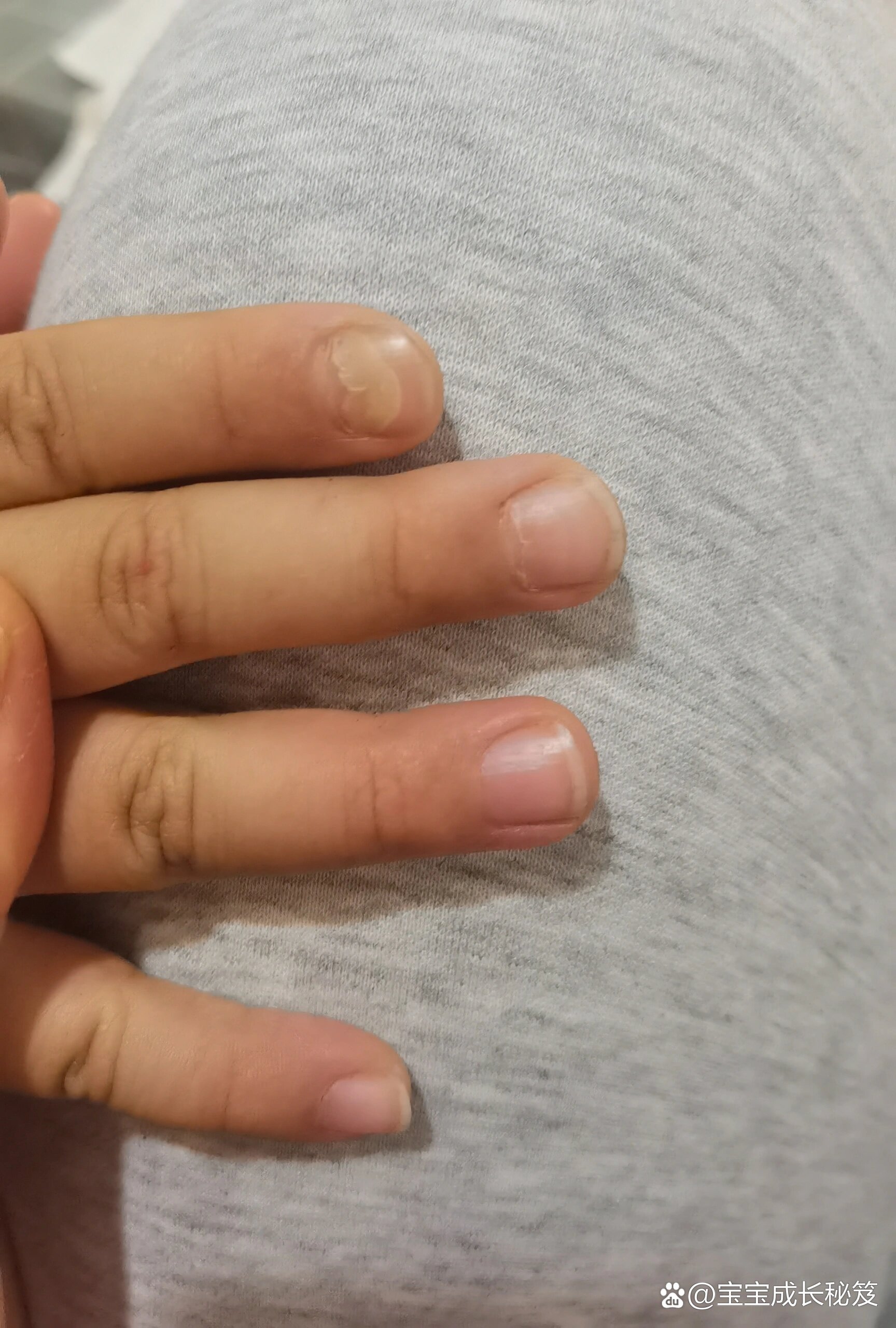  p>小孩手足口后半个月出现空甲 br>最近孩子指甲出现空甲,越来越严重