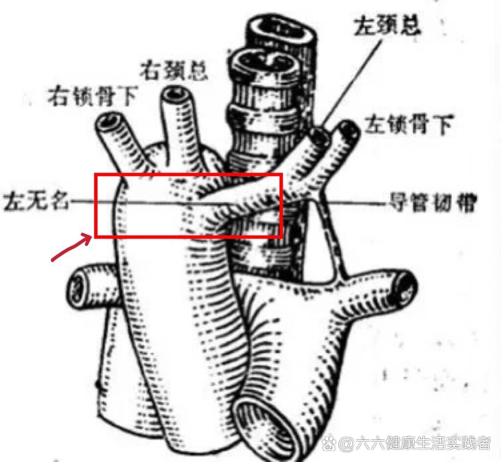 双主动脉弓图片图片