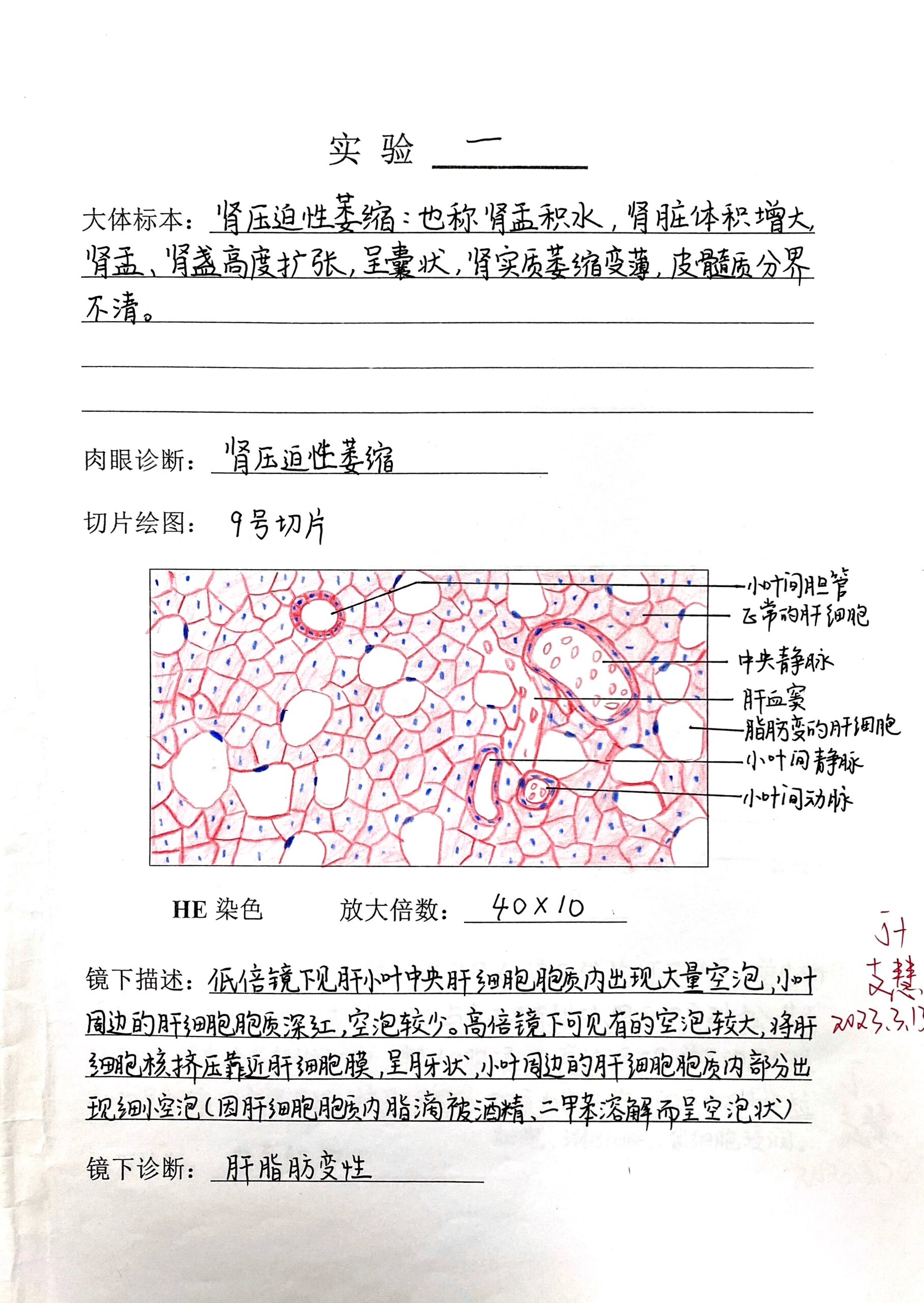 学期画的病理实验报告7715当时给保留了下来  br>p1  肝脂肪变性