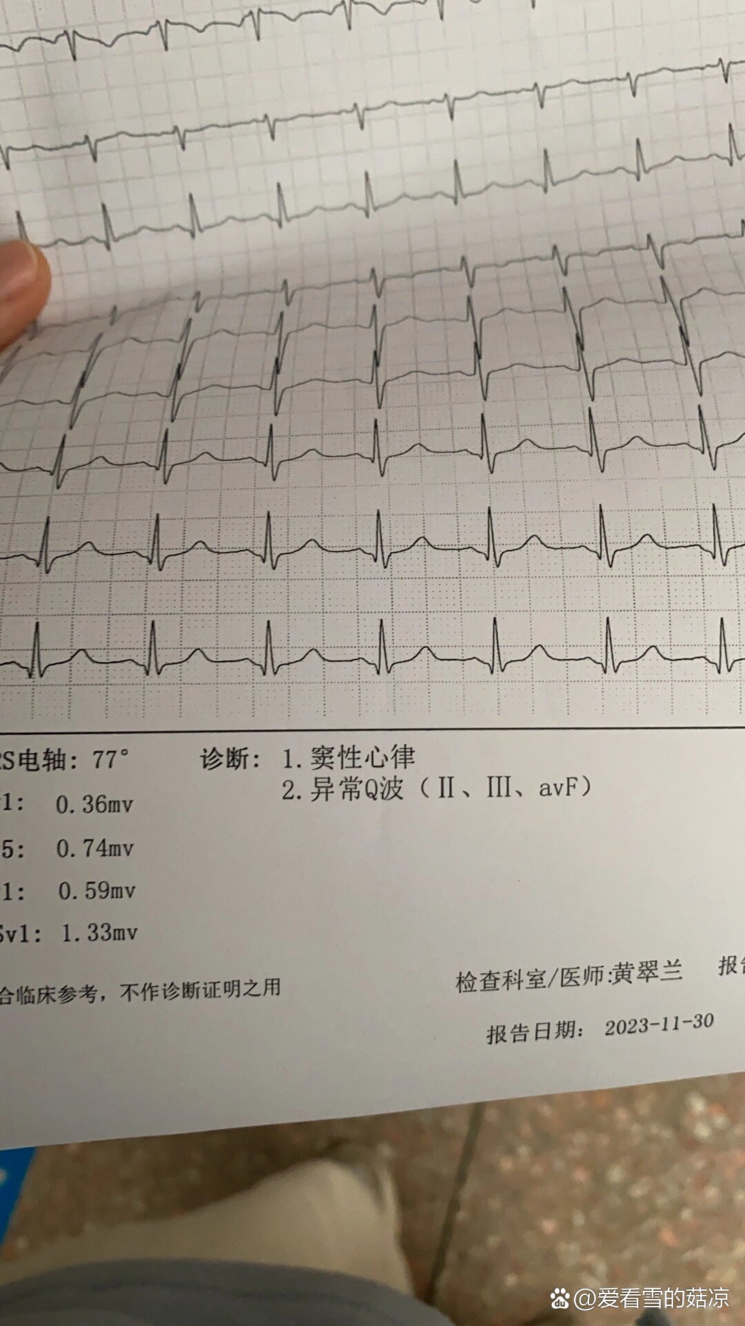 异常q波是什么意思图片