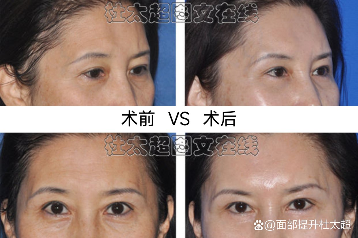 额部皱纹如何抚平？