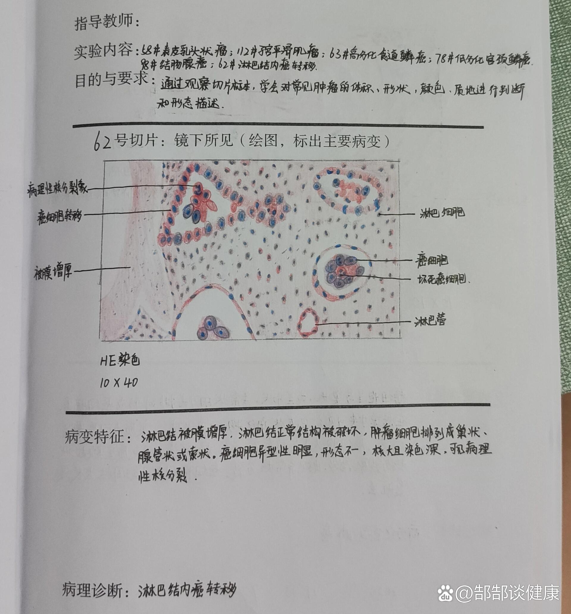 病理学报告(高分化食道鳞癌,淋巴结内癌转移)