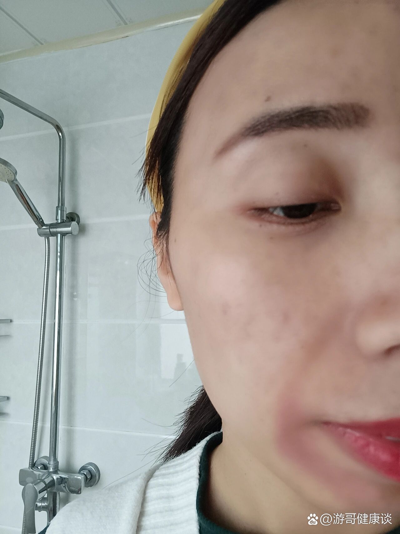 口周炎如何治疗