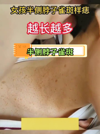 女孩颈部雀斑样痣,胎记与咖啡斑的区别