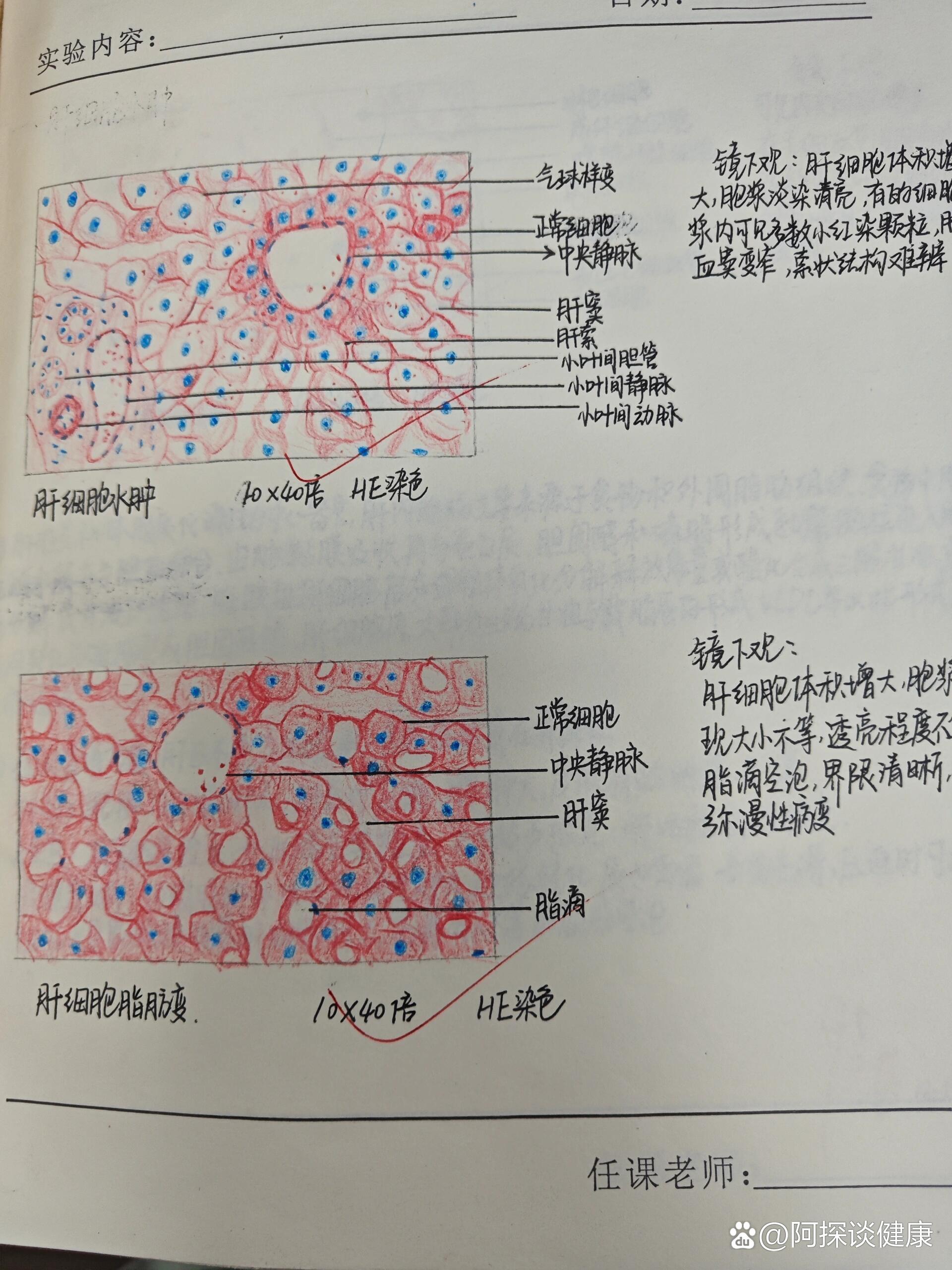 肝细胞水肿切片图图片