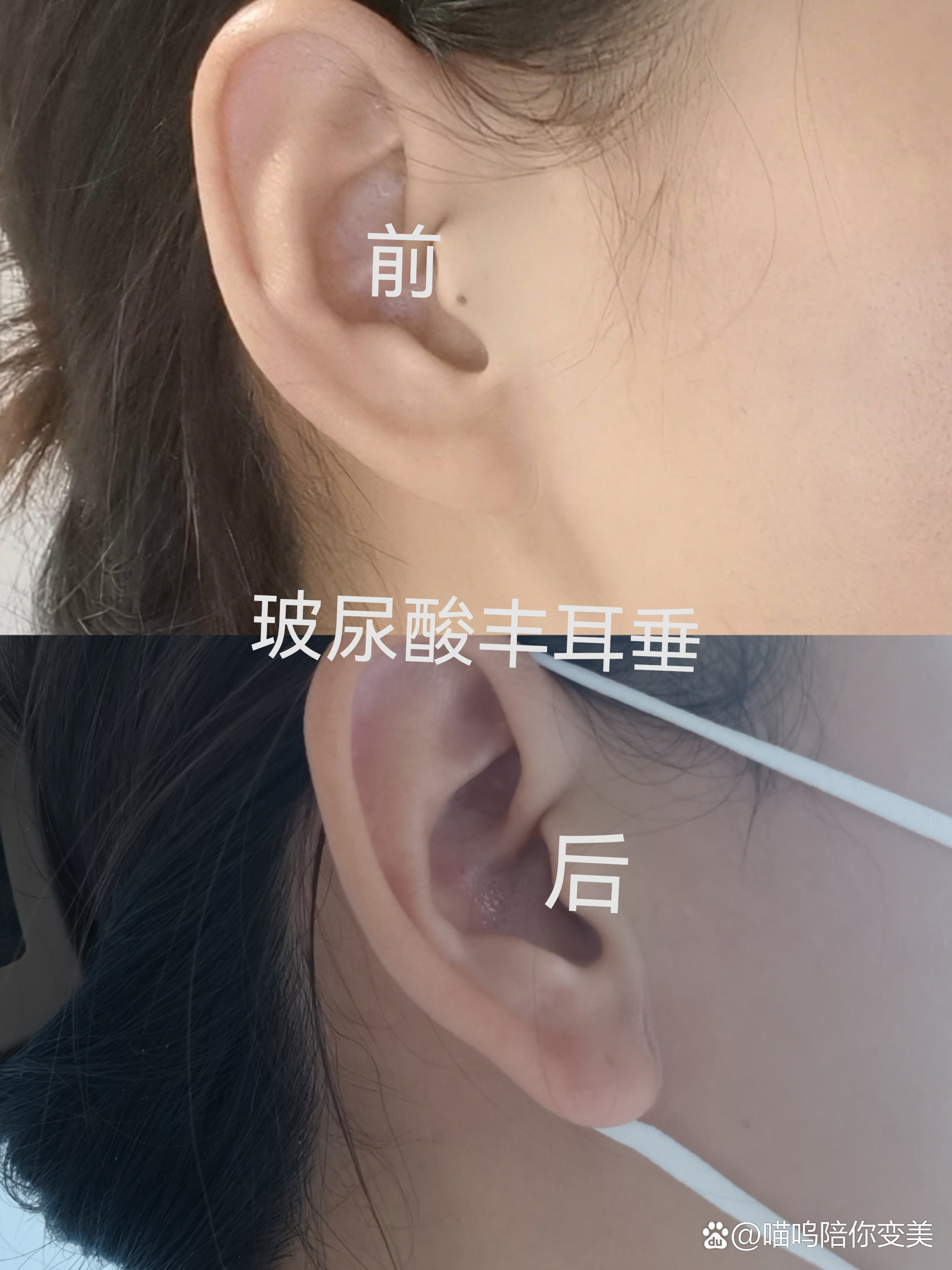 打耳钉后可以做玻尿酸丰耳垂吗