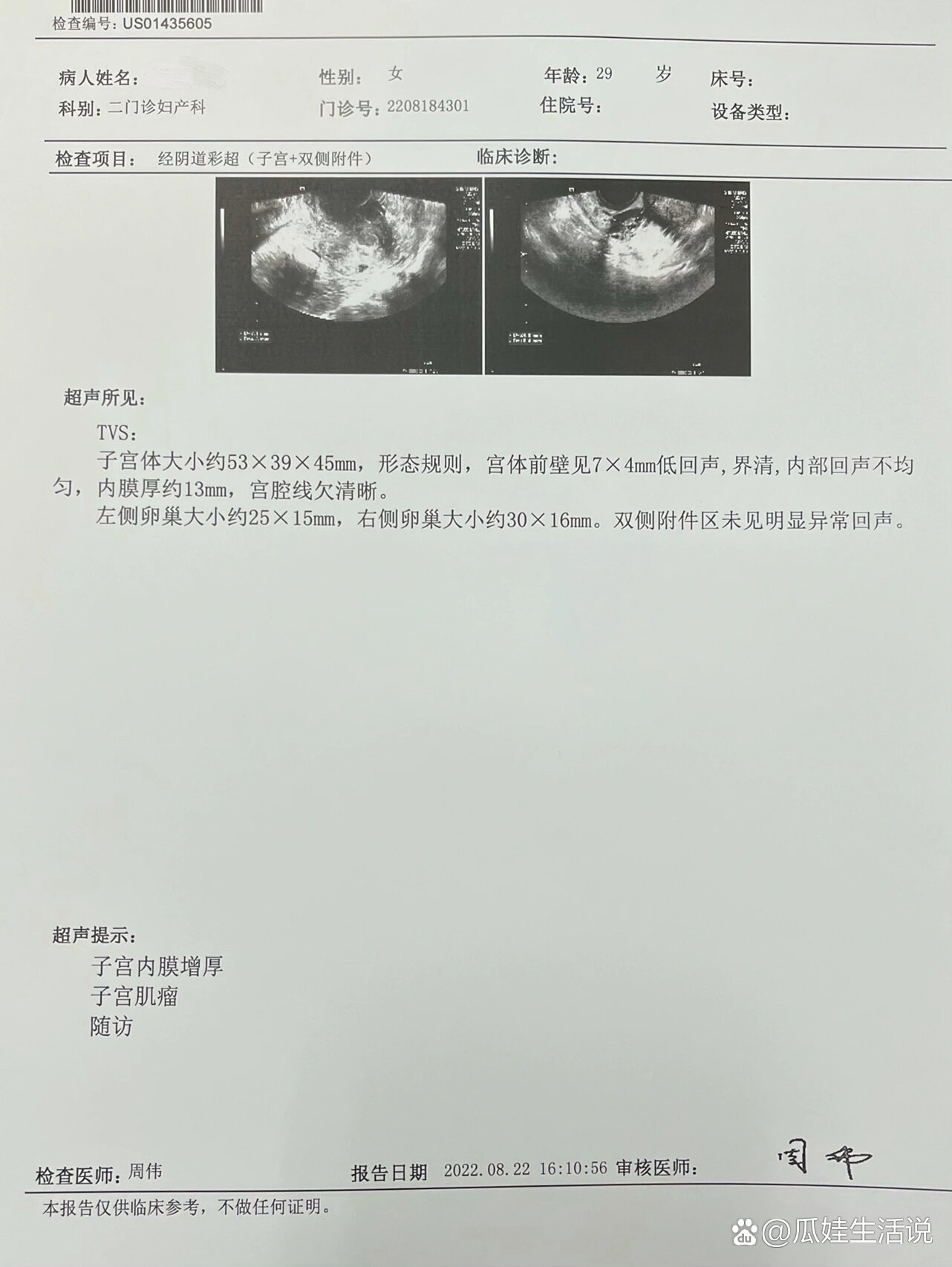 子宫肌瘤图片彩超图片