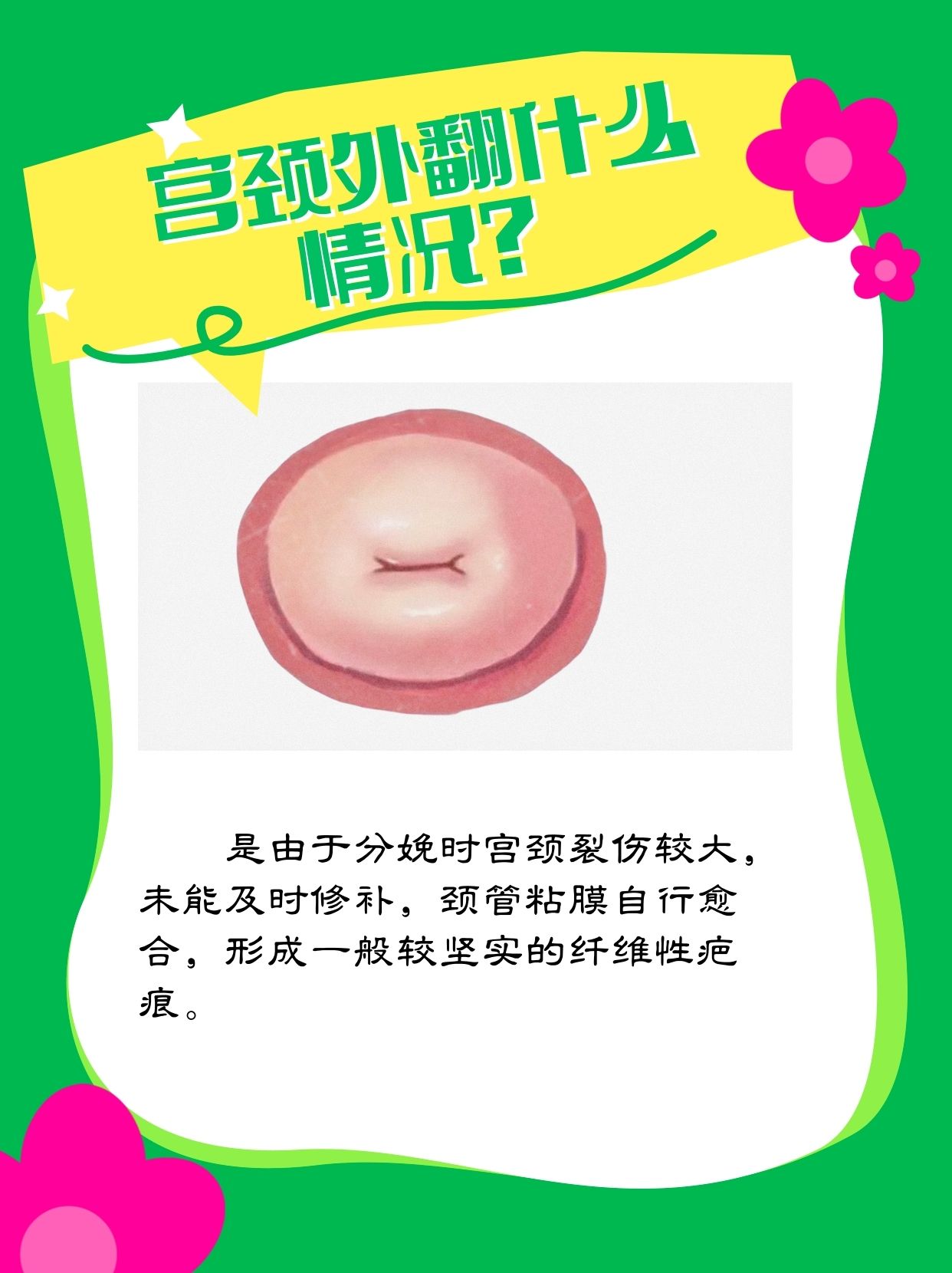 宫颈外翻?别担心,听我慢慢告诉你!