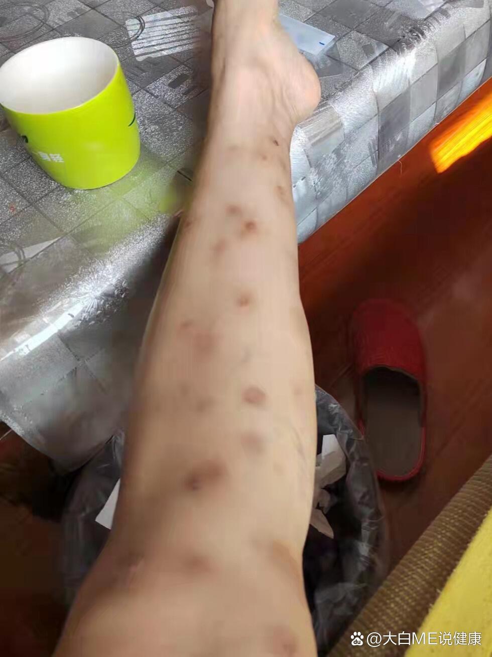结节性痒疹好了,现在全是印了
