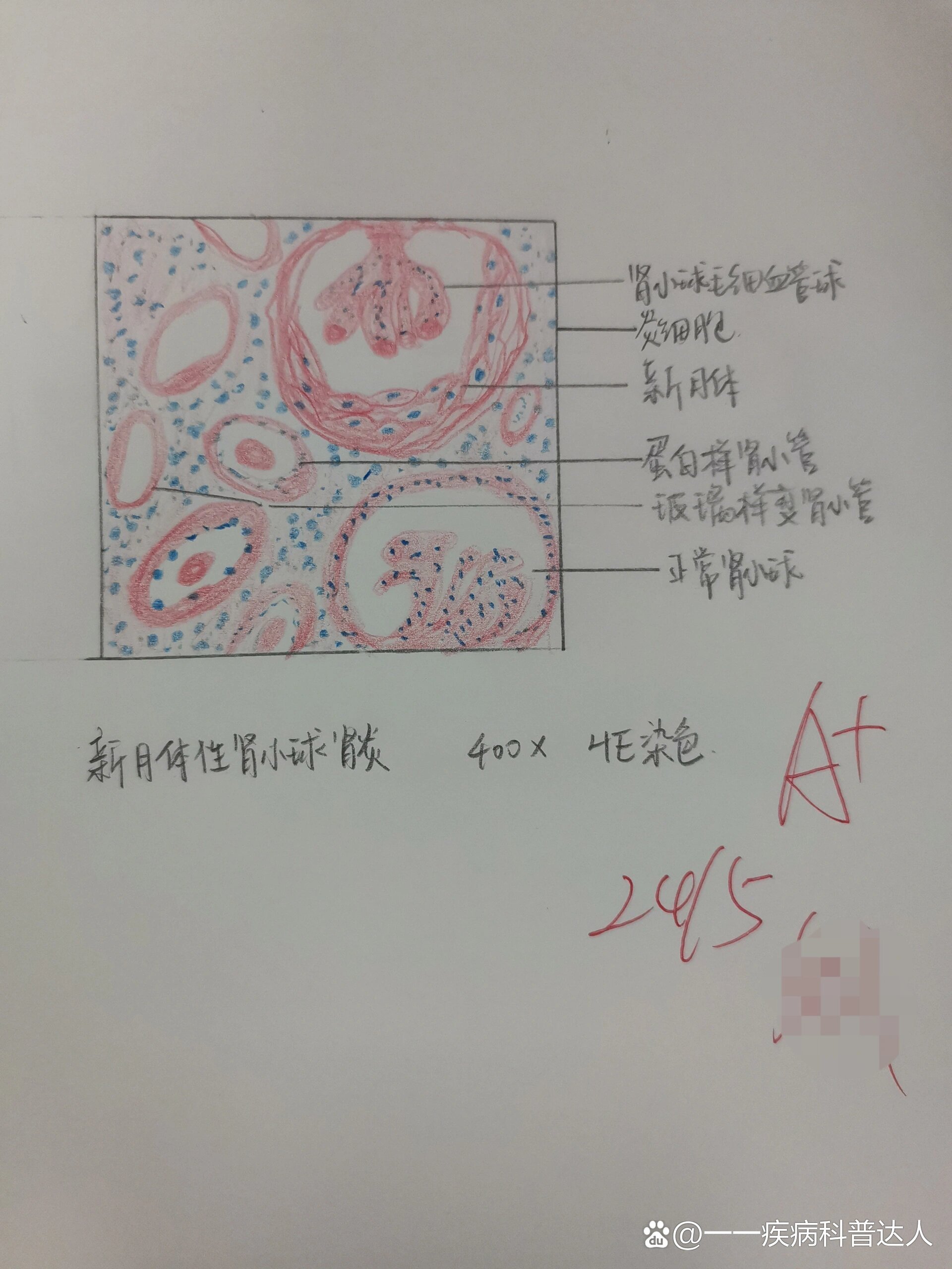 新月体性肾小球肾炎