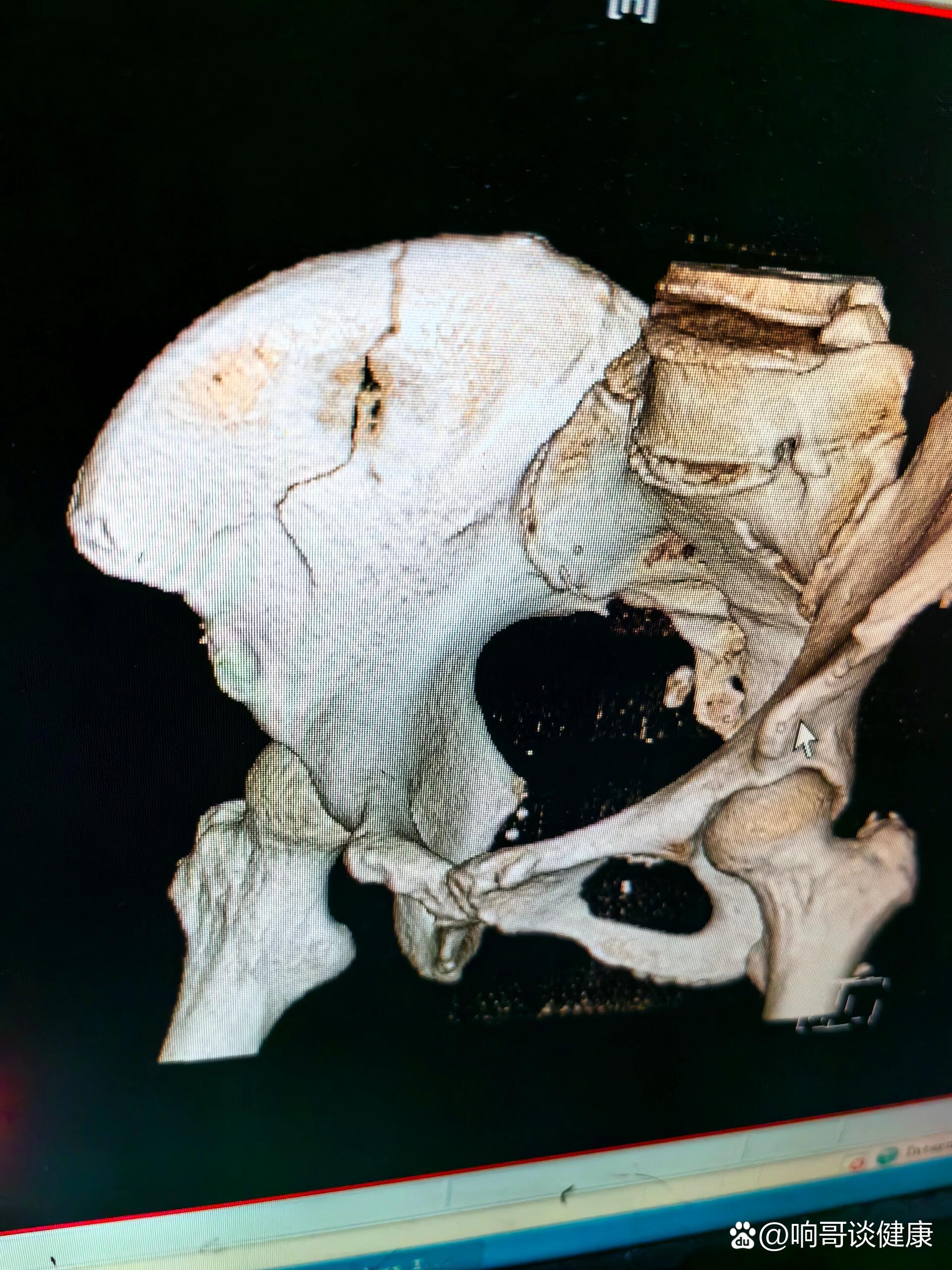 坐骨ct断层解剖图图片