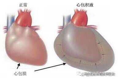 心包积液图解图片