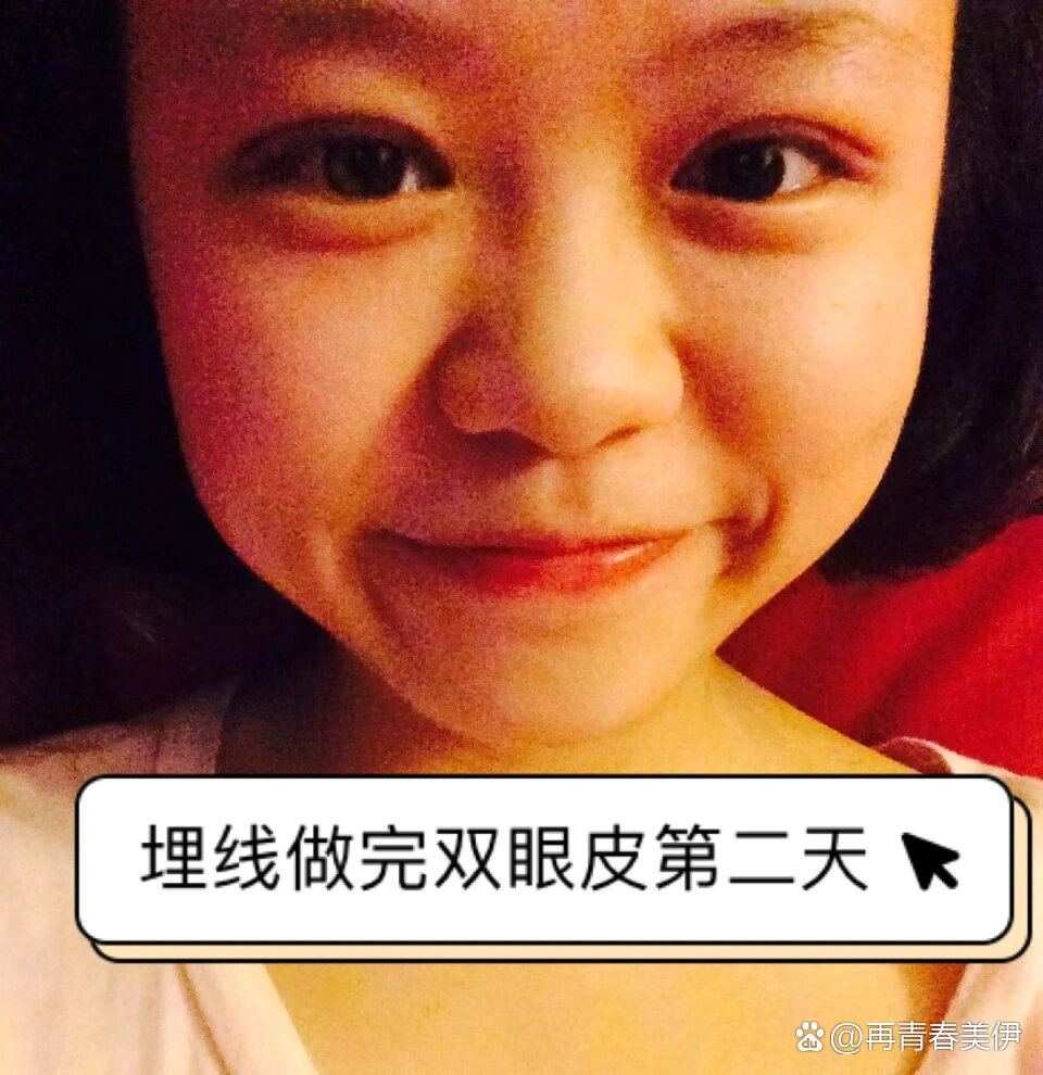 做完埋线双眼皮五年之后