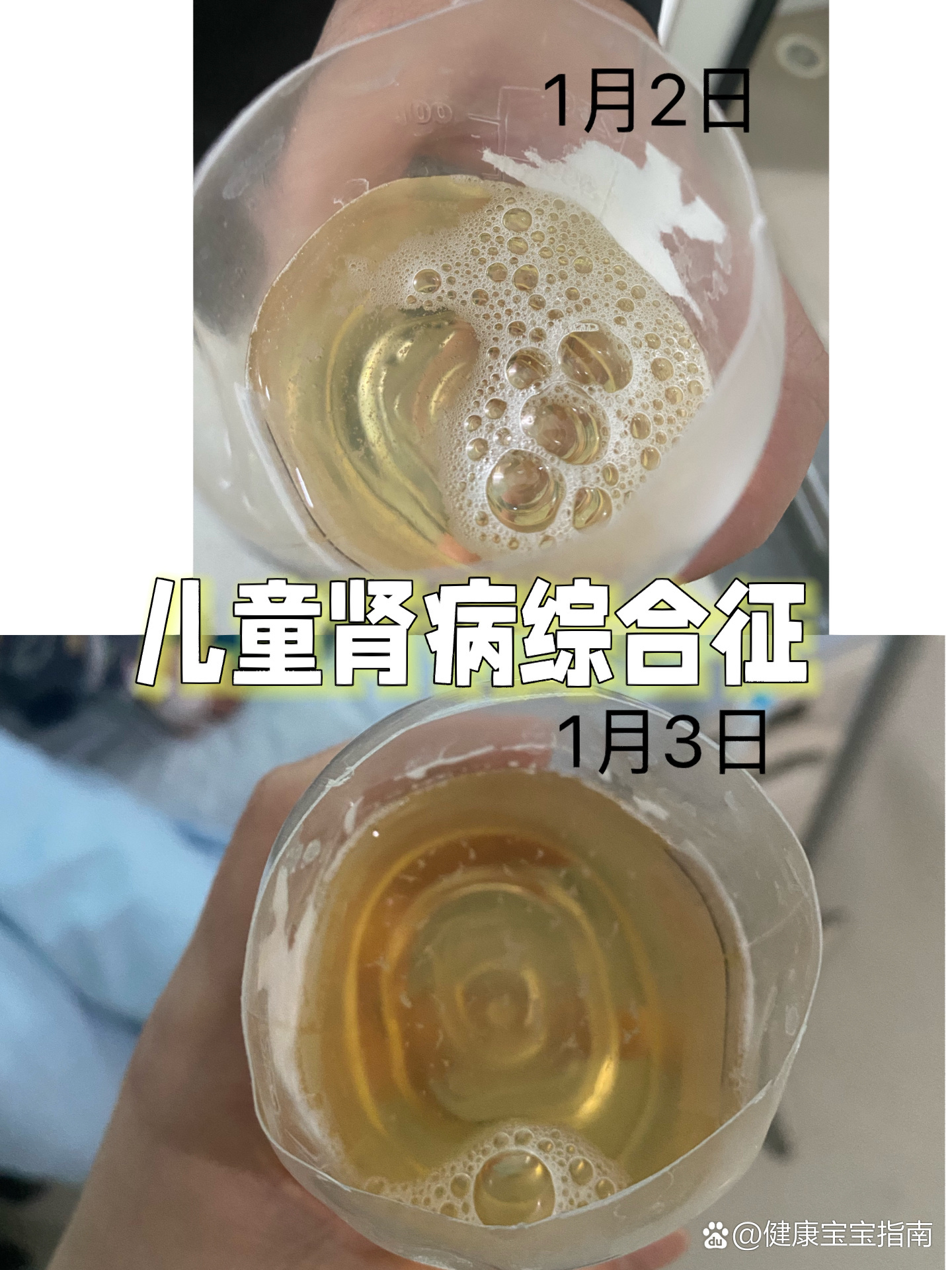 肾病综合症