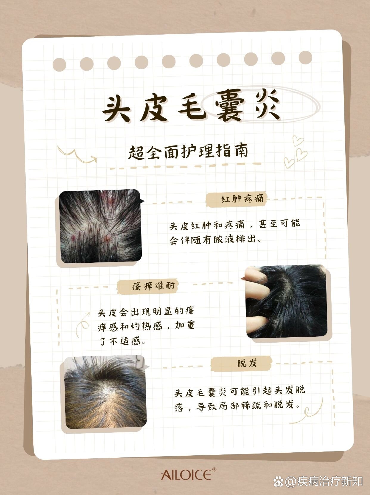 头皮毛囊炎护理指南:这一篇就够了!