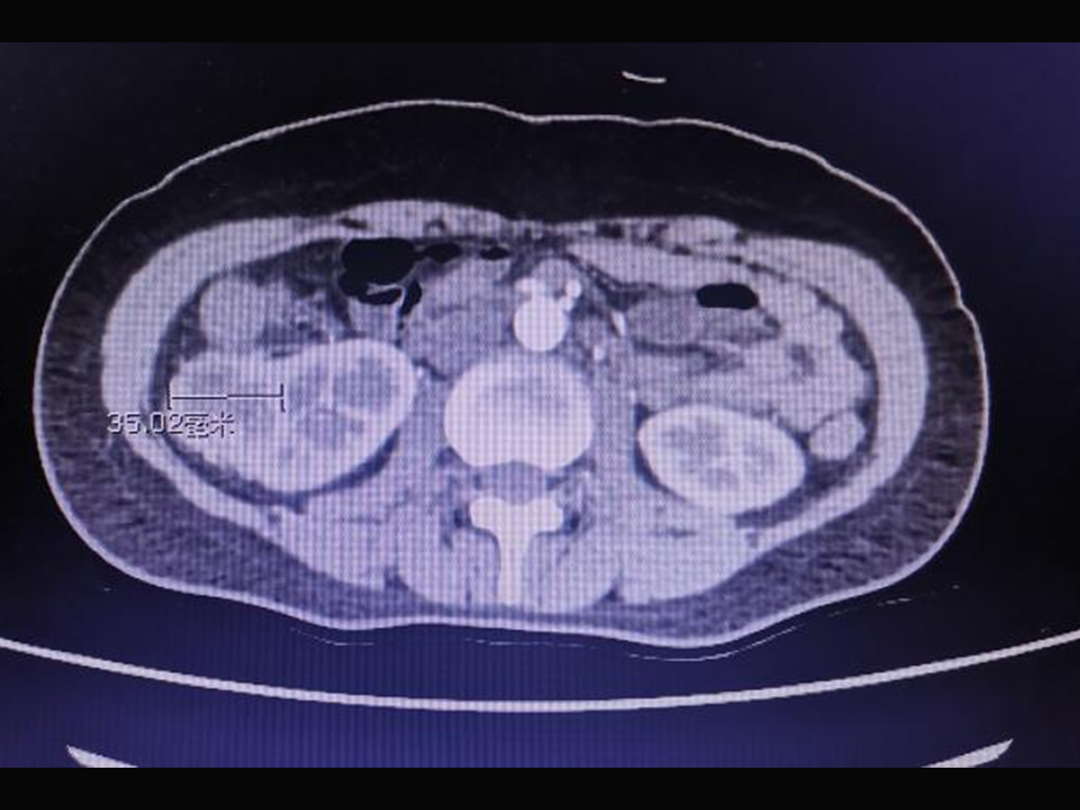 肾癌增强ct图片图片