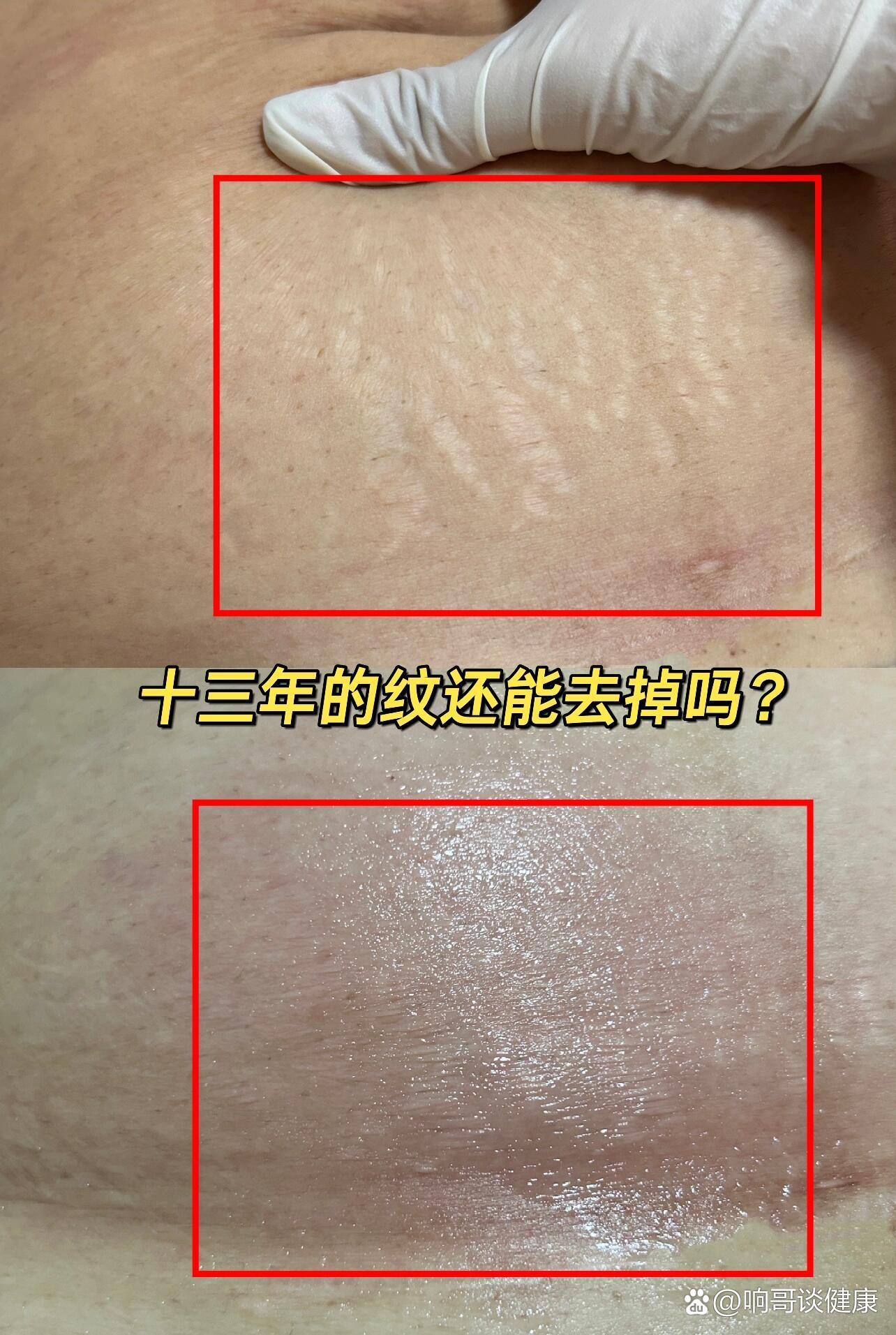 十三年的妊娠纹还能去掉吗?