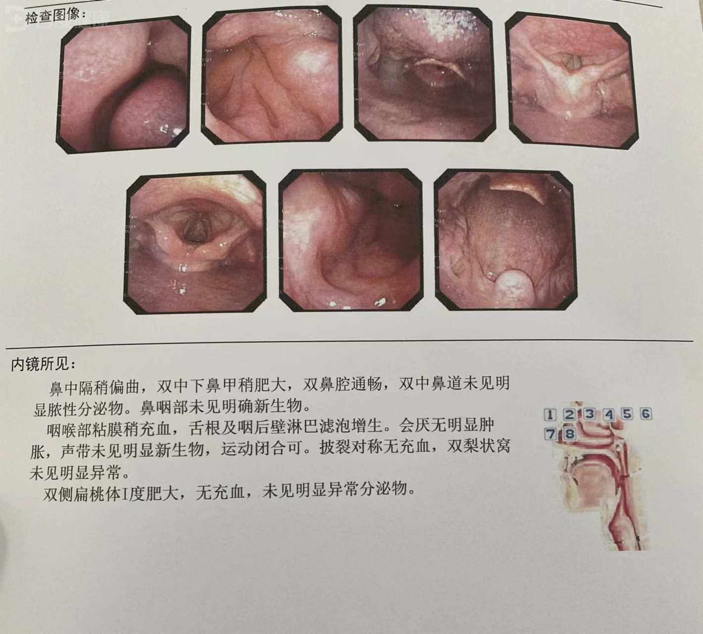 鼻咽癌的淋巴肿大图片图片