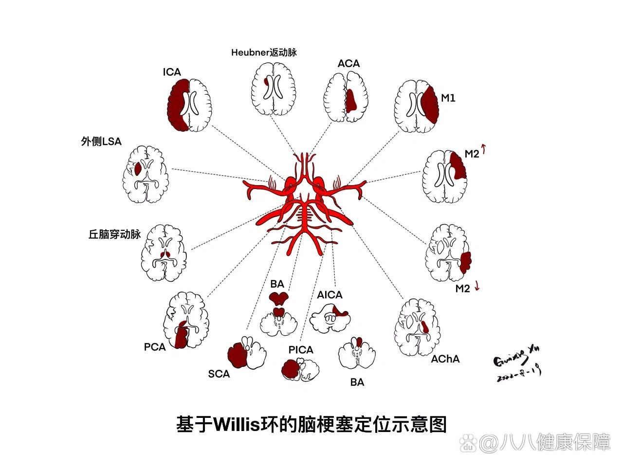 脑梗示意图图片图片