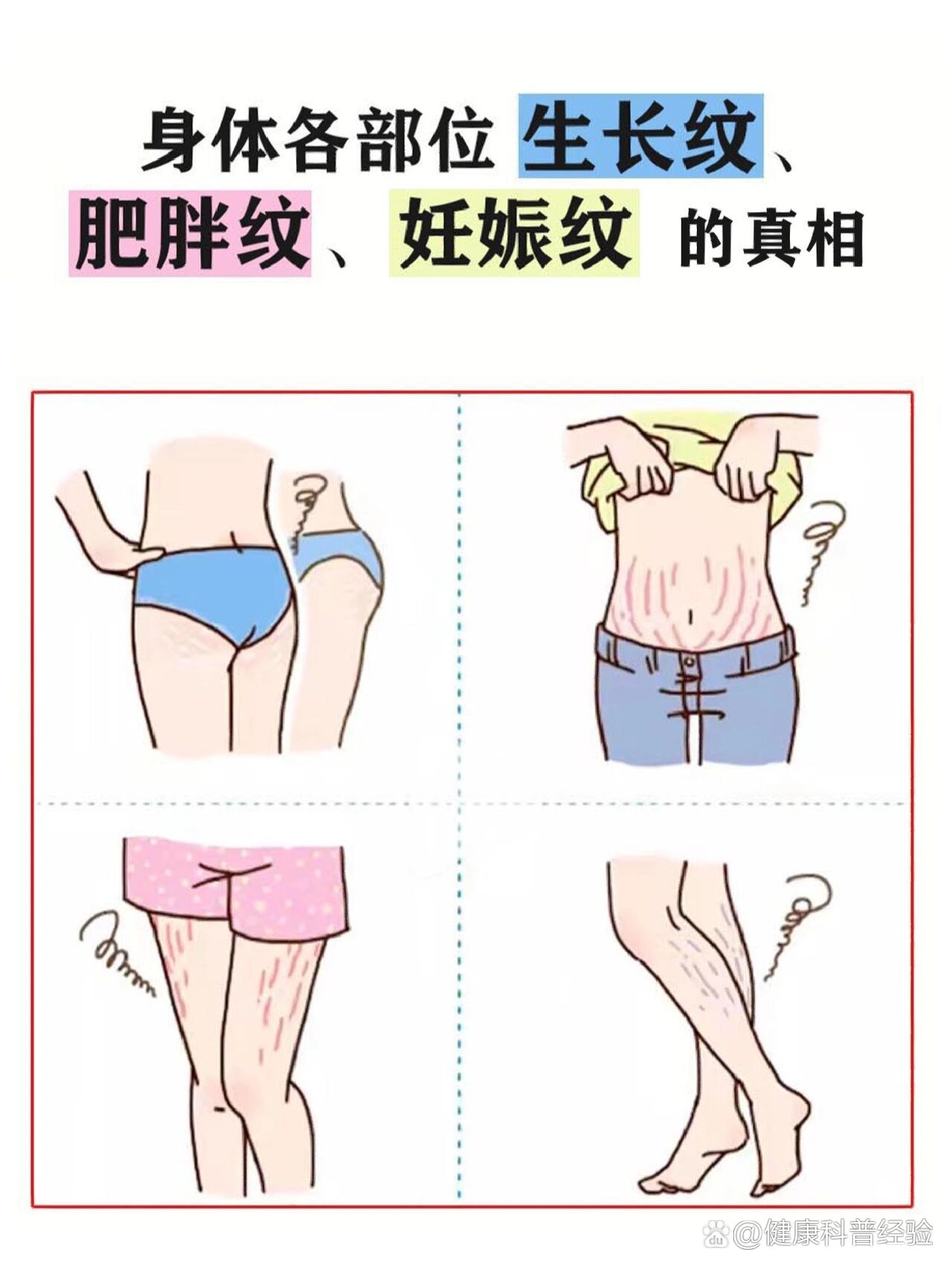 身体长妊娠纹,肥胖纹的真相6015