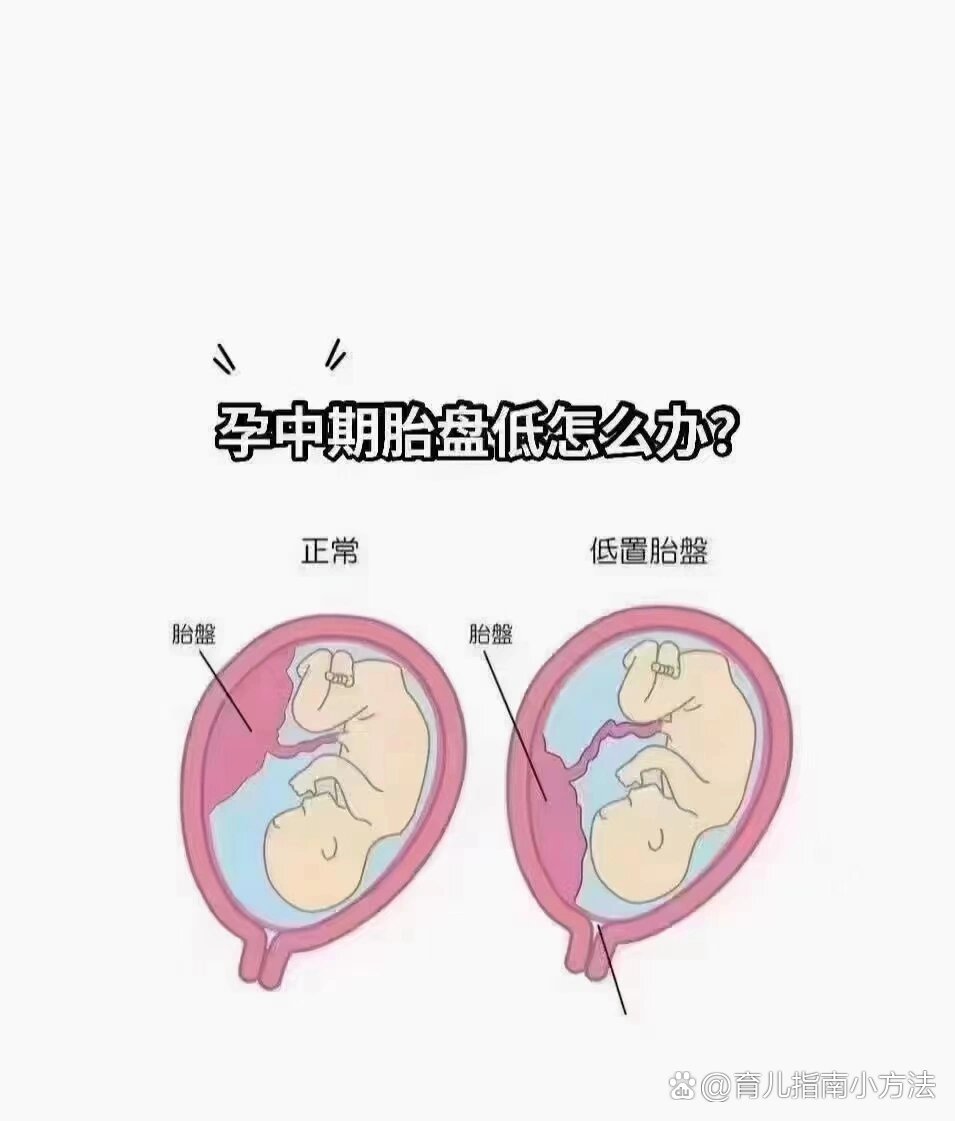 低置胎盘注意事项