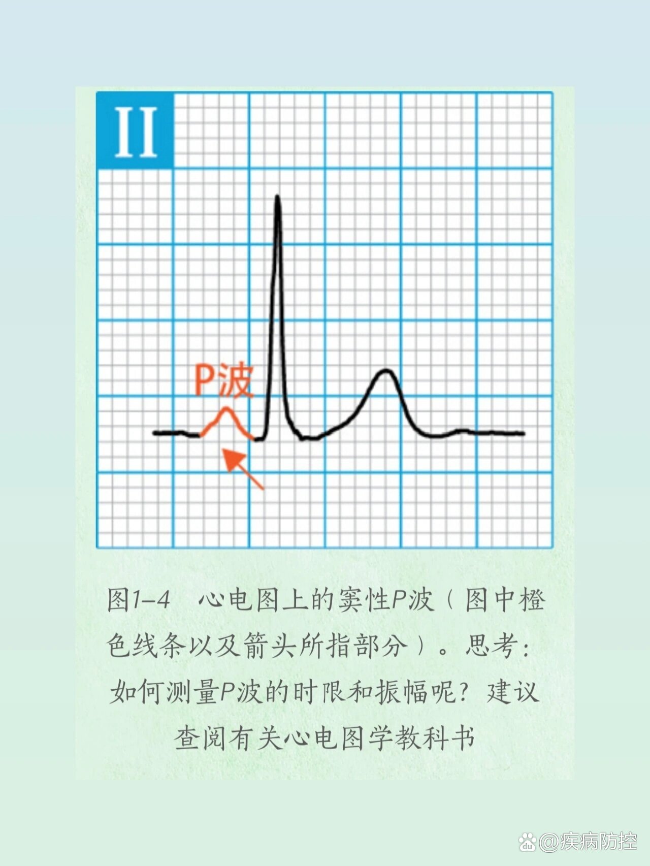 day2 教你认识心电图的p波