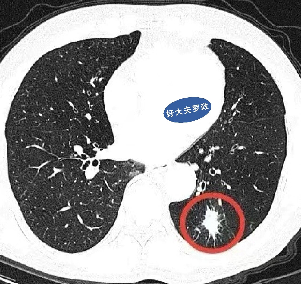 分享一个有毛刺的随访明确性质的肺结节