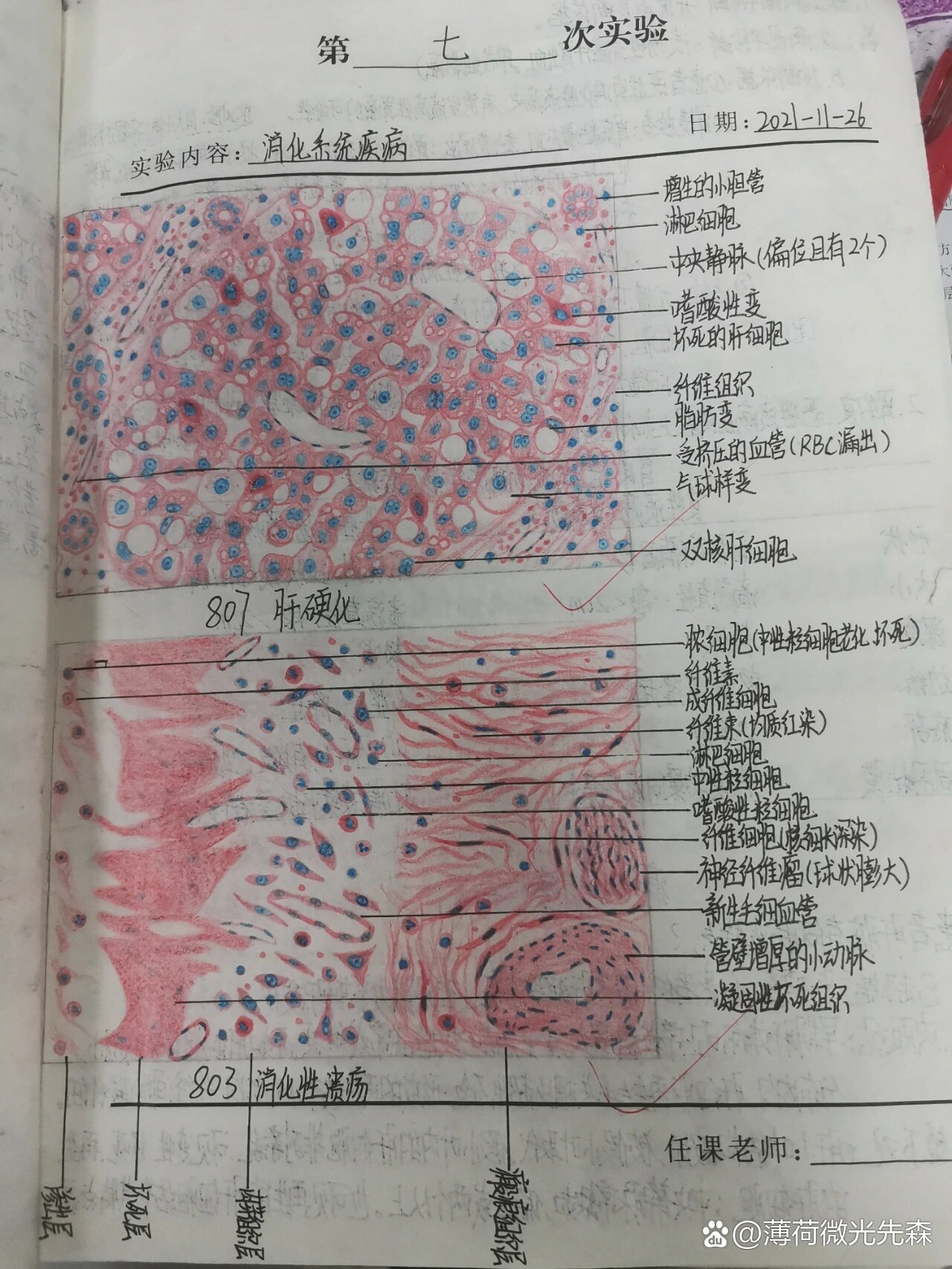 脾凝固性坏死手绘图图片