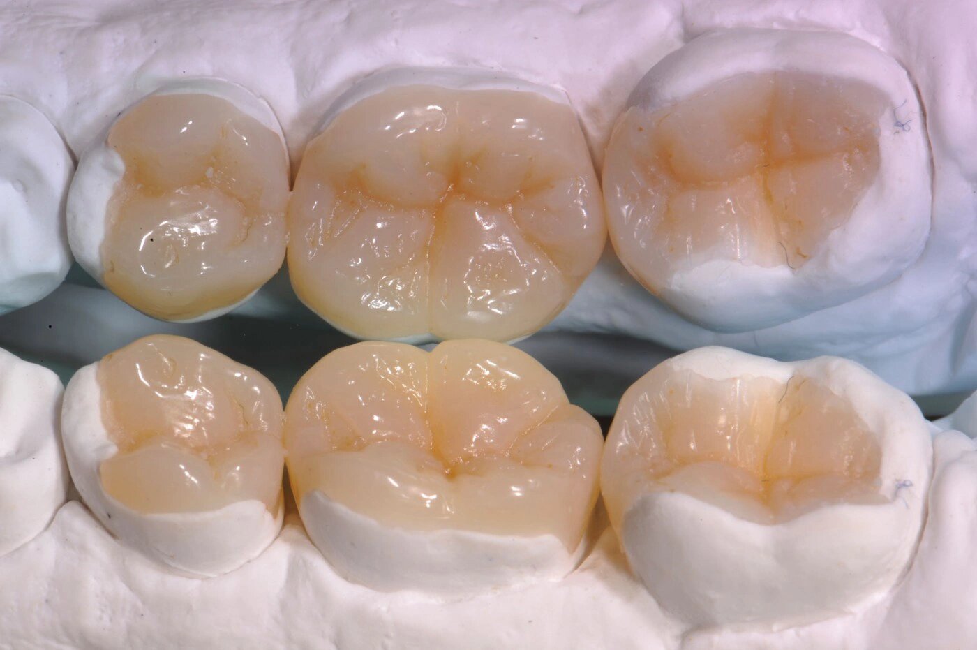 更精准的修复方式—嵌体