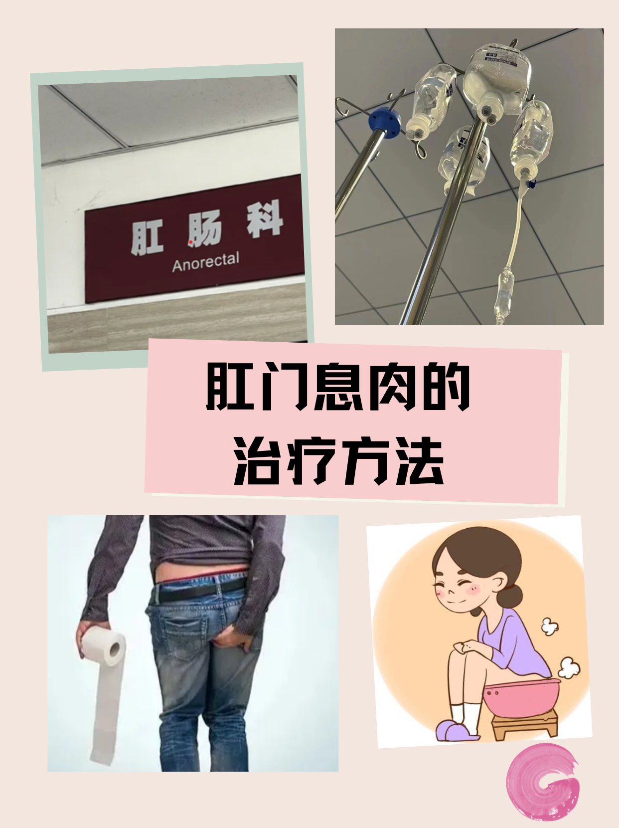 肛门息肉会癌变吗图片