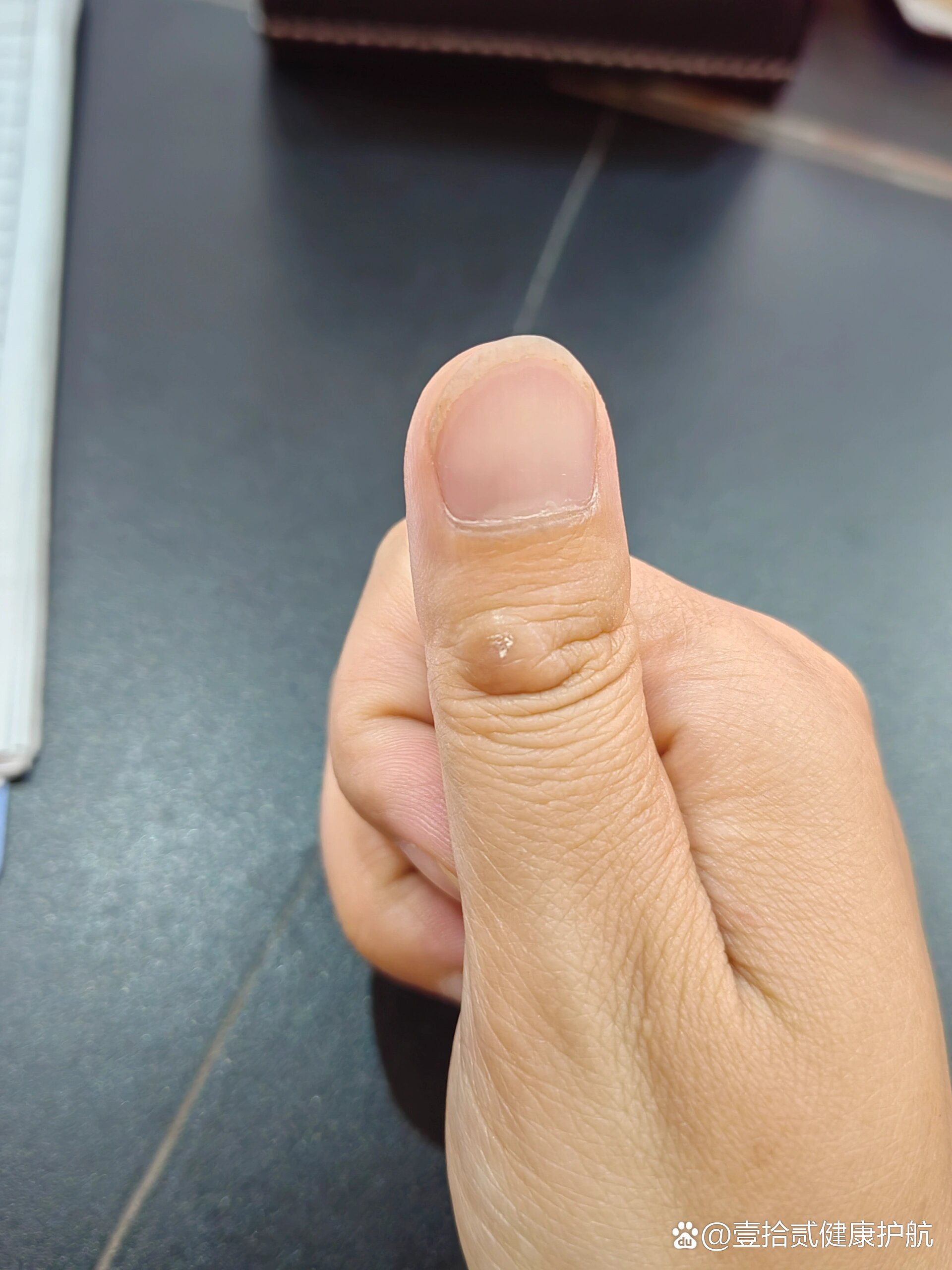 手指头上的硬疙瘩