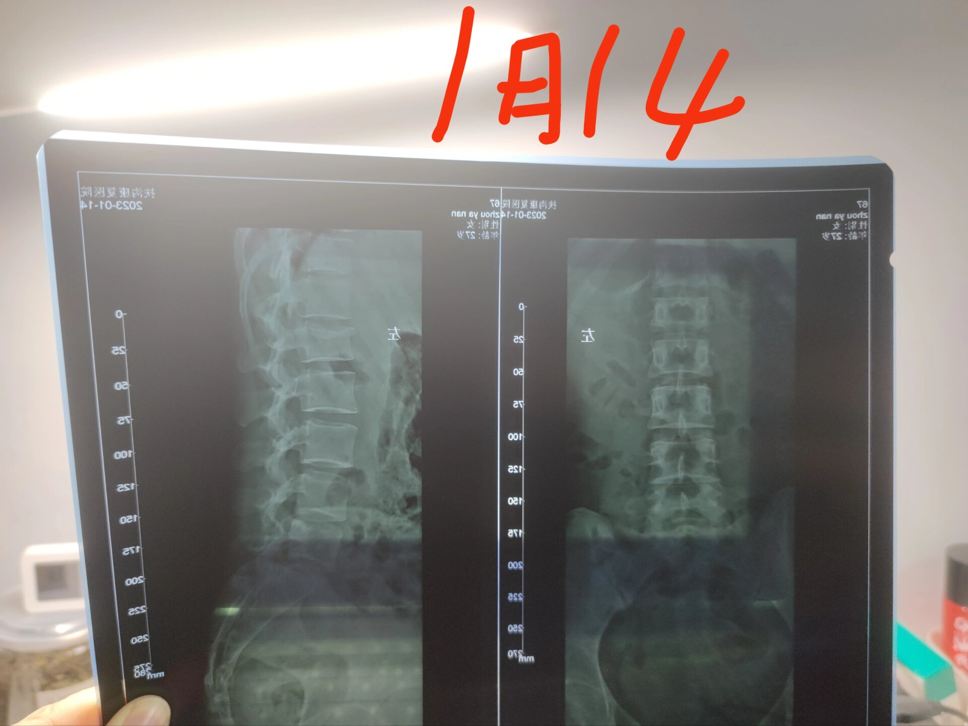 腰椎压缩性骨折两个月