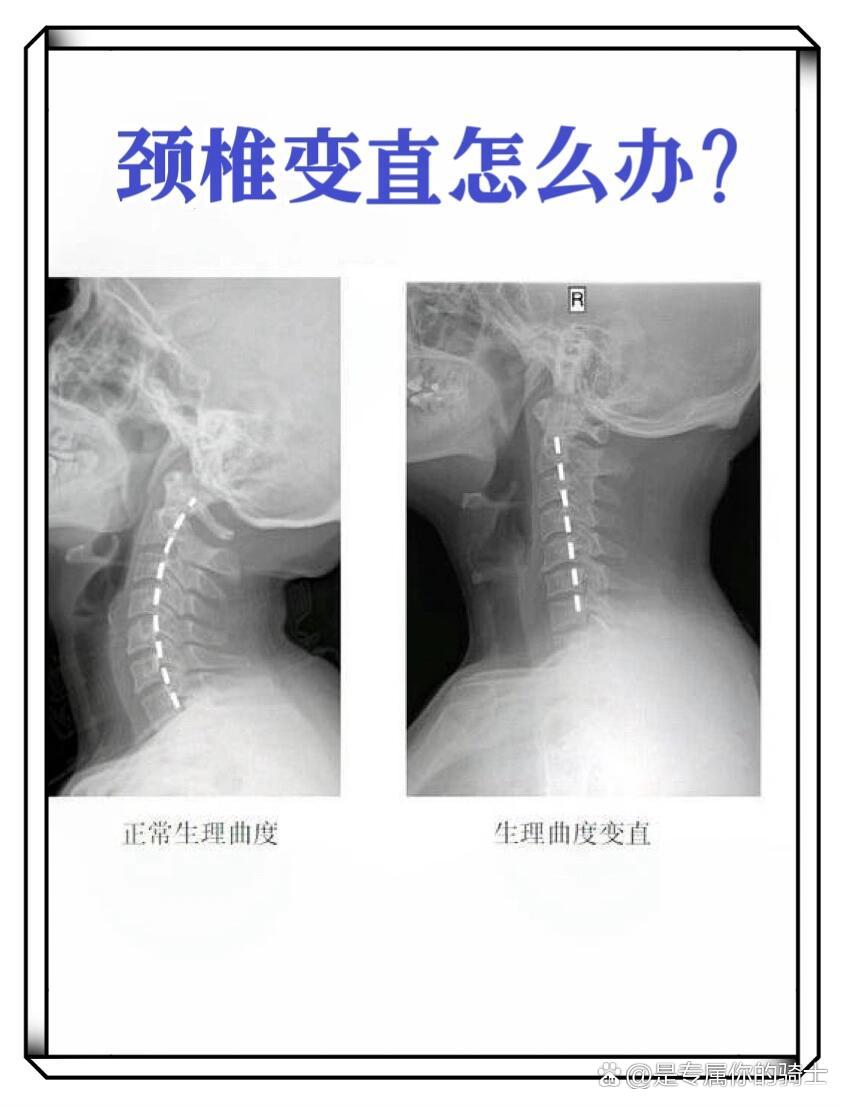 颈强直检查图片图片