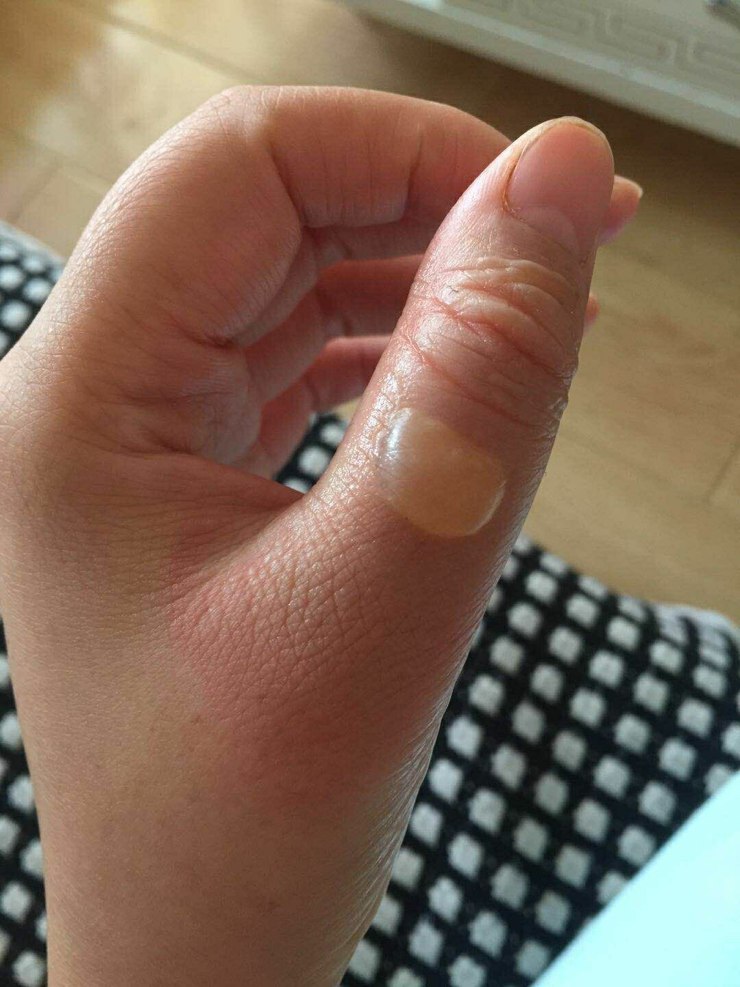 手废了,马上用凉水冲,冲了有半小时,拿出来还是火辣辣,家里也没有烫伤