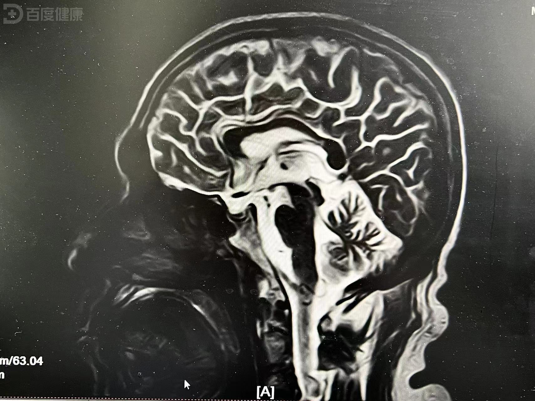 患者出现走路不稳肢体抖动，竟是进行性核上性麻痹导致-医疗科普-百度健康