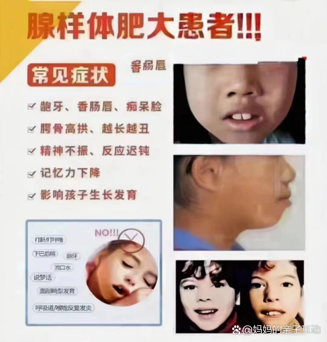 腺样体肥大会对孩子造成什么样的影响和危害