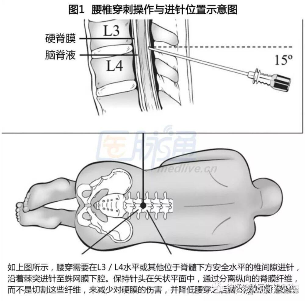 腰椎穿刺术