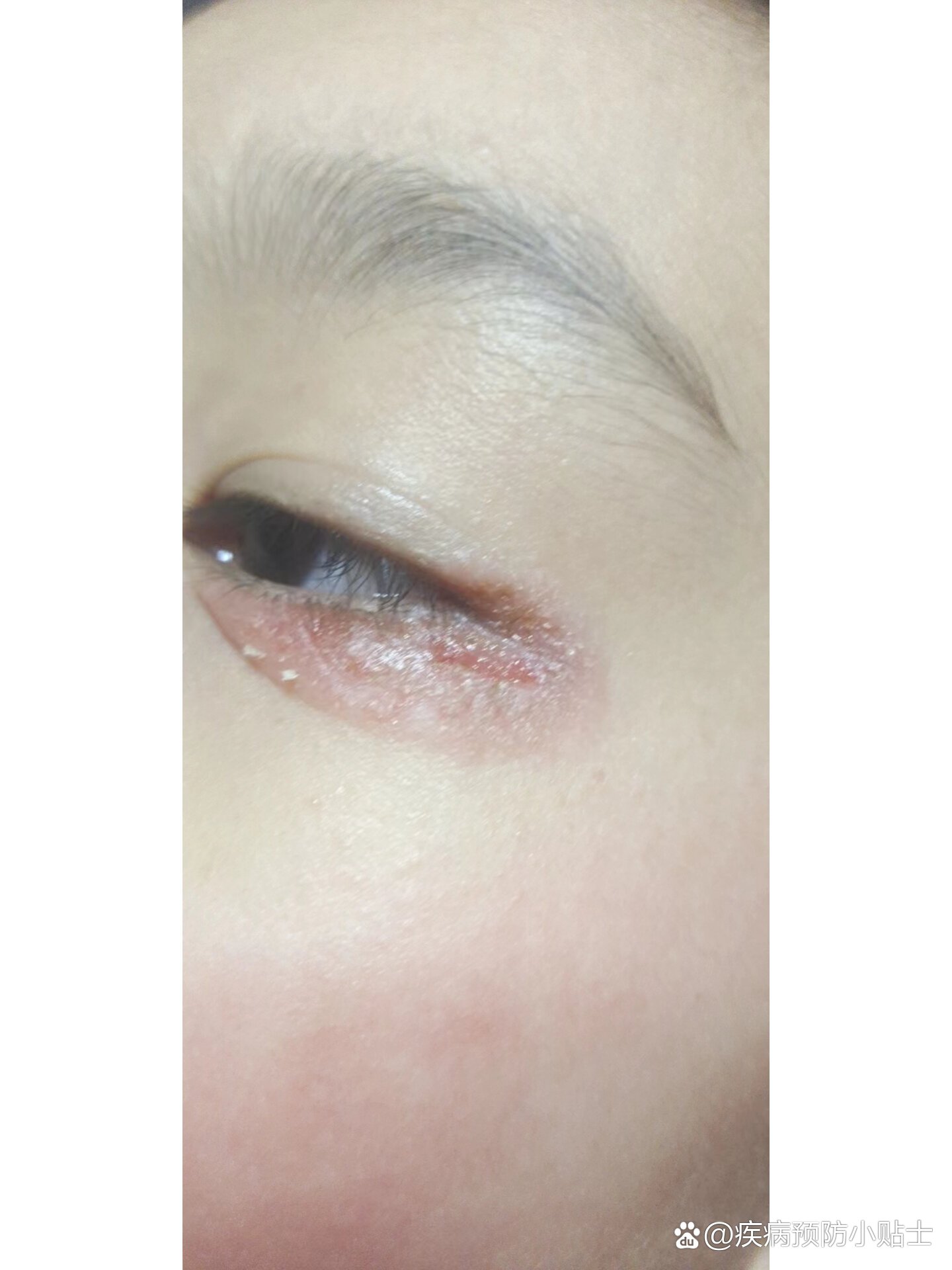 小孩子眼角溃烂