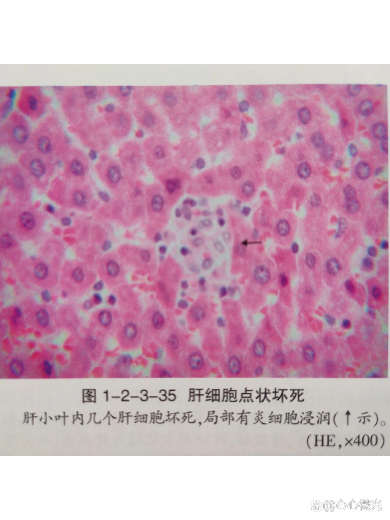 肝脏凝固性坏死图片