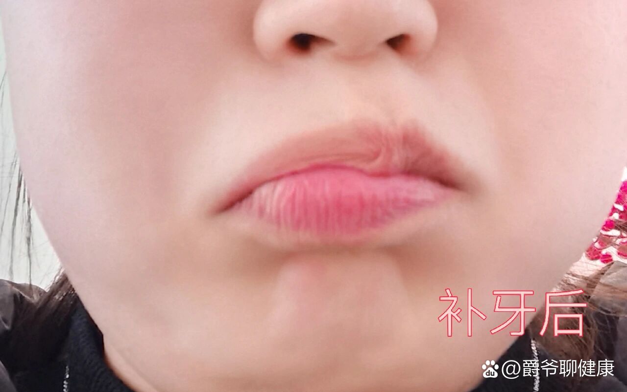 补牙打麻药后嘴歪了