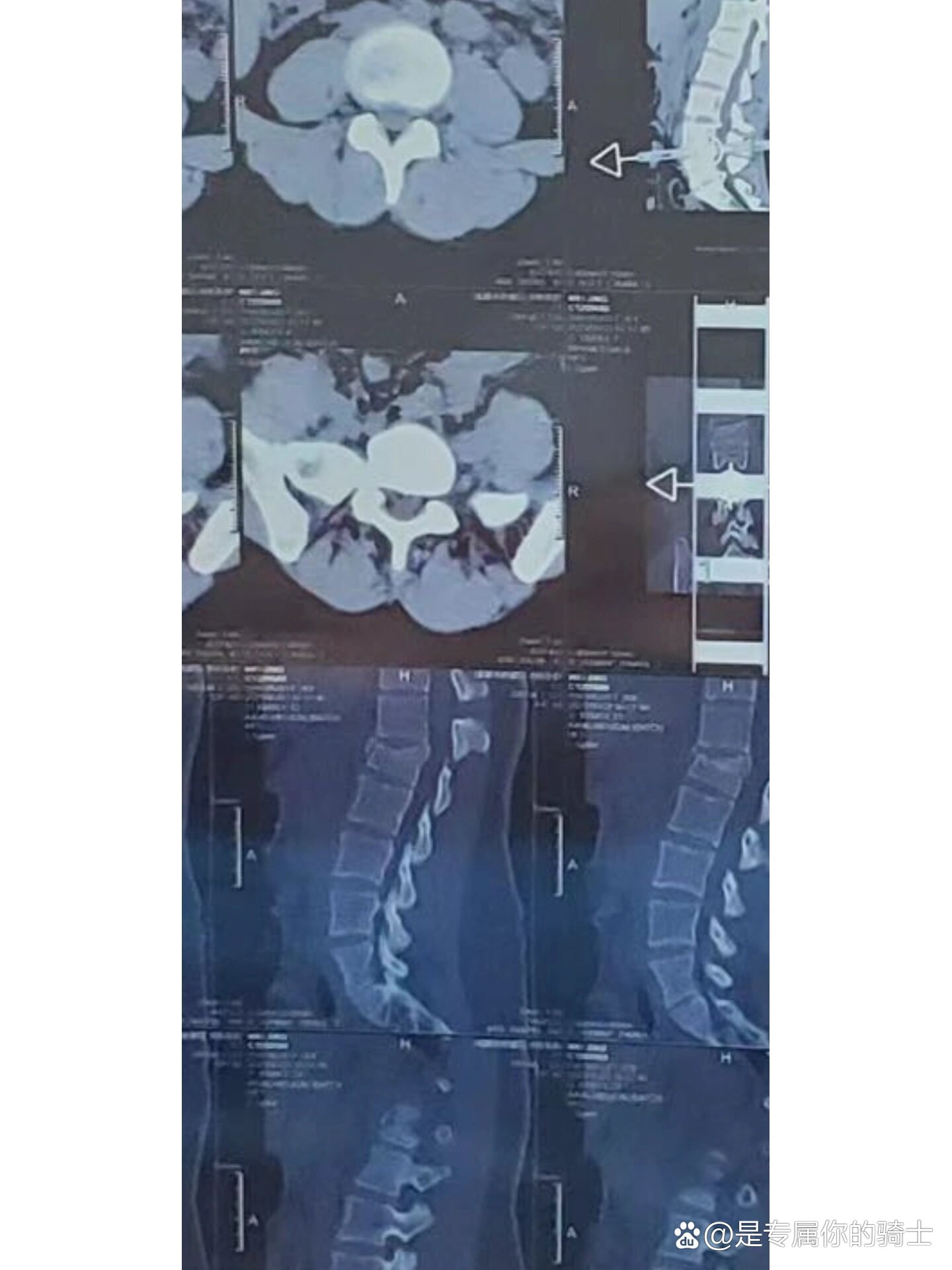 腰椎l1压缩性骨折