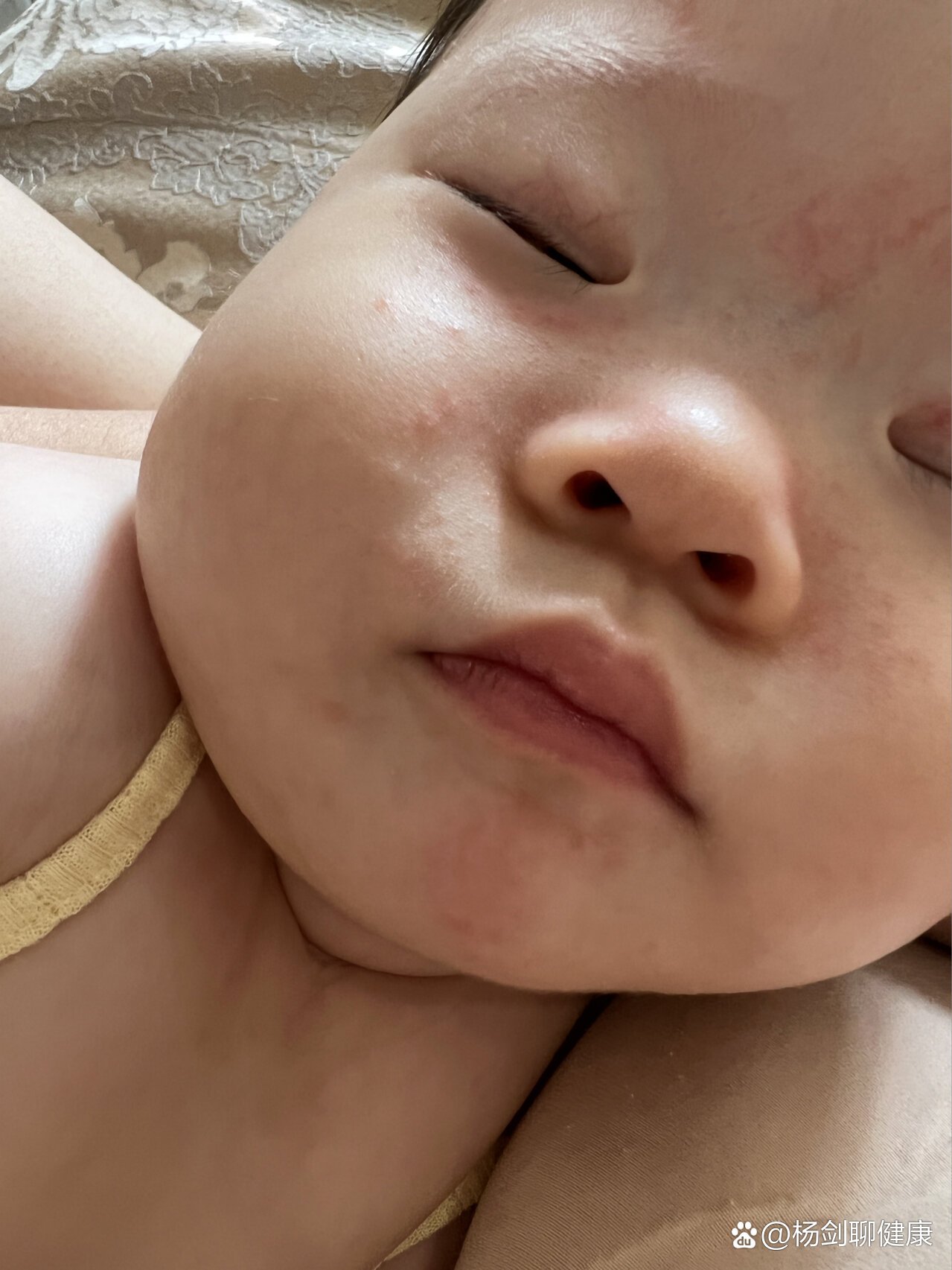 五联疫苗后的疹子