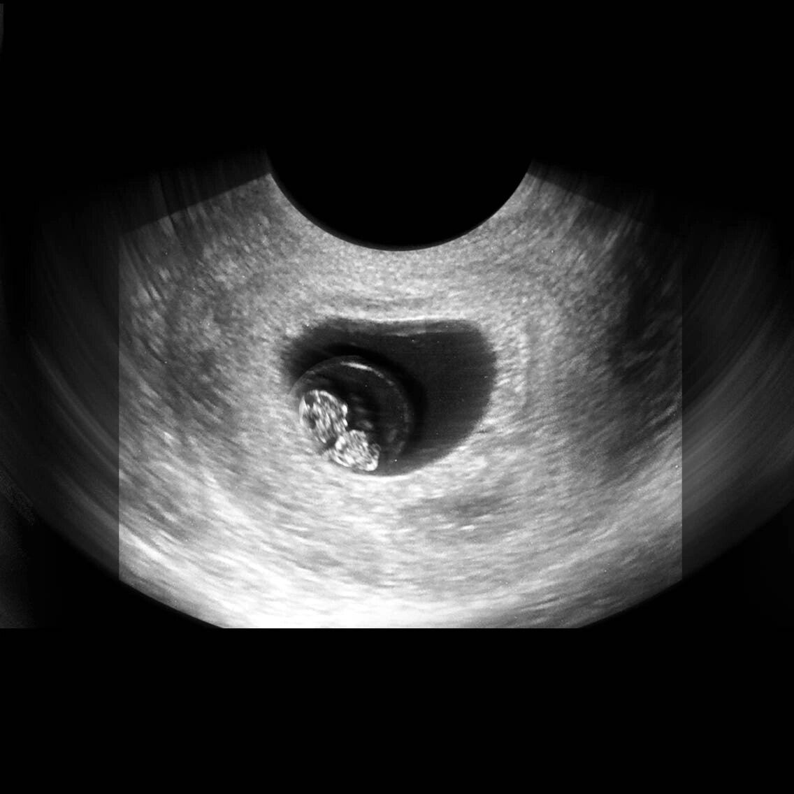 孕7周查了胎心胎芽